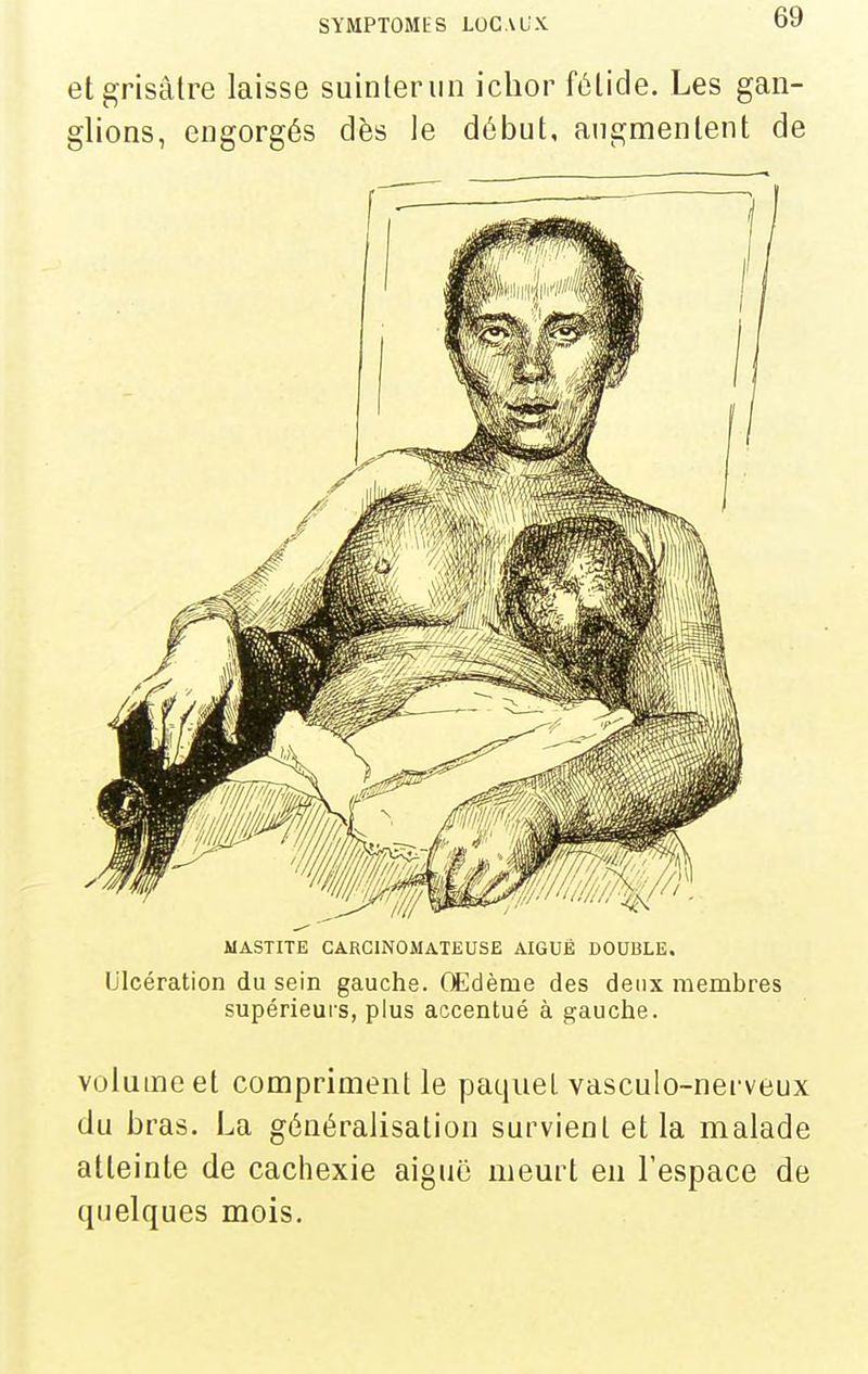 et grisâtre laisse suinteriin iclior fétide. Les gan- glions, engorgés dès le début, augmentent de MASTITE CARCINOMATEUSE AIGUË DOUBLE. Ulcération du sein gauche. (Edème des deux membres supérieurs, plus accentué à gauche. volume et compriment le paquet vasculo-nerveux du bras. La généralisation survient et la malade atteinte de cachexie aiguë meurt en l'espace de quelques mois.