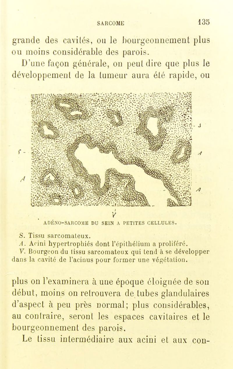 grande des cavités, ou le bourgeonnement plus ou moins considérable des parois. D'une façon générale, ou peul dire que plus le développement de la tumeur aura élé rapide, ou Y ADÉN0-SA.RC0J1E DU SEIN A PETITES CELLULES. S. Tissu sarcomateux. A. Arini hypertrophiés dont l'épithélium a proliféré. V. Bourgeon du (issu sarcomateux qui tend à se développer dans la cavité de l'acinus pour former une végétation. plus ou l'examinera à une époque éloiguée de sou début, moins on retrouvera de tubes glandulaires d'aspect h peu près normal; plus considérables, au coniraire, seront les espaces cavilaires et le bourgeonnement des parois. Le tissu intermédiaire aux acini et aux con-