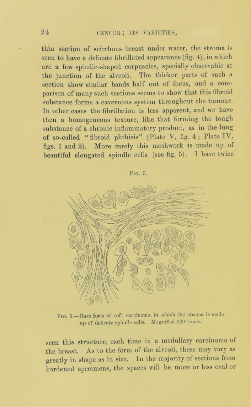 thin section of scirrhous breast under water, the stroma is seen to have a delicate fibrillated appearance (fig. 4), in which are a few spindle-shaped corpuscles, specially observable at the junction of the alveoli. The thicker parts of such a section show similar bauds half out of focus, and a com- parison of many such sections seems to show that this fibroid substance forms a cavernous system throughout the tumour. In other cases the fibrillation is less apparent, and we have then a homogeneous texture, like that forming the tough substance of a chronic inflammatory product, as in the lung of so-called “ fibroid phthisis” (Plate V, fig. 4; Plate IV, figs. 1 and 2). More rarely this mesliwork is made up of beautiful elongated spindle cells (see fig. 5). I have twice Fio. 5. Fig. 5.— Rare form of soft carcinoma, in which the stroma is made np of delicate spindle cells. Magnified 220 times. seen this structure, each time in a medullary carcinoma of the breast. As to the form of the alveoli, these may vary as greatly in shape as in size. In the majority of sections from hardened specimens, the spaces will be more or less oval or