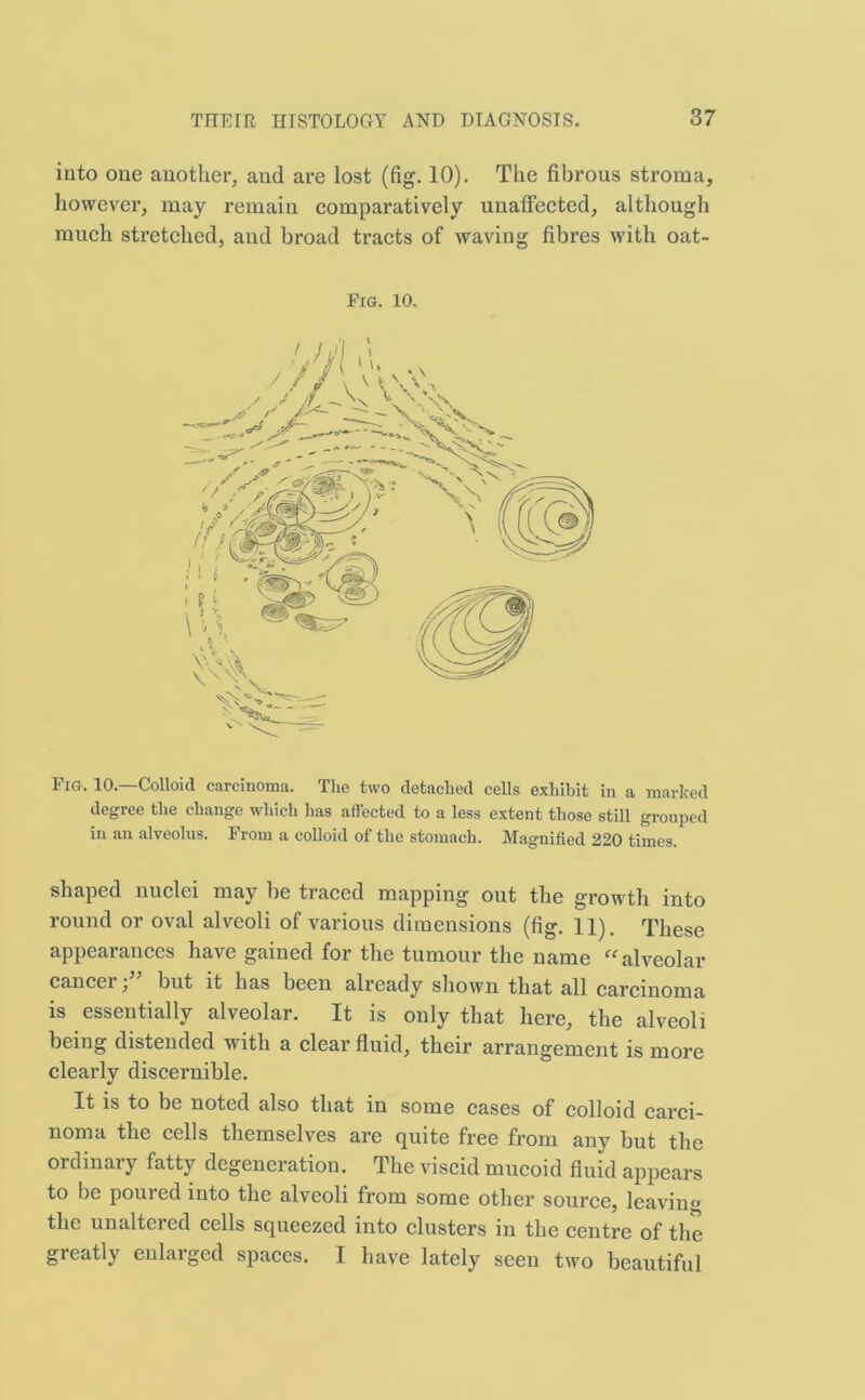 into one another, and are lost (fig. 10). The fibrous stroma, however, may remain comparatively unaffected, although much stretched, and broad tracts of waving fibres with oat- Fig. 10—Colloid carcinoma. The two detached cells exhibit in a marked degree the change which has affected to a less extent those still grouped in an alveolus. From a colloid of the stomach. Magnified 220 times. shaped nuclei may he traced mapping out the growth into round or oval alveoli of various dimensions (fig. 11). These appearances have gained for the tumour the name “alveolar cancer, but it has been already shown that all carcinoma is essentially alveolar. It is only that here, the alveoli being distended with a clear fluid, their arrangement is more clearly discernible. It is to be noted also that in some cases of colloid carci- noma the cells themselves are quite free from any but the ordinary fatty degeneration. The viscid mucoid fluid appears to be poured into the alveoli from some other source, leaving the unaltered cells squeezed into clusters in the centre of the greatly enlarged spaces. I have lately seen two beautiful Fig. 10.