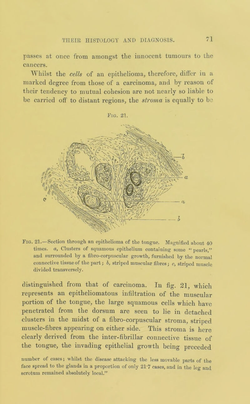 passes at once from amongst the innocent tumours to the cancers. Whilst the cells of an epithelioma, therefore, differ iu a marked degree from those of a carcinoma, and by reason of their tendency to mutual cohesion are not nearly so liable to be carried oft' to distant regions, the stroma is equally to be Fig. 21. Fig. 21.—Section through an epithelioma of the tongue. Magnified about 40 times, a, Clusters of squamous epithelium containing some “pearls,” and surrounded by a fibro-corpuscular growth, furnished by the normal connective tissue of the part; b, striped muscular fibres; c, striped muscle divided transversely. distinguished from that of carcinoma. In fig. 21, which represents an epitlieliomatous infiltration of the muscular portion of the tongue, the large squamous cells which have penetrated from the dorsum are seen to lie in detached clusters in the midst of a fibro-corpuscular stroma, striped muscle-fibres appearing on either side. This stroma is here clearly derived from the inter-fibrillar connective tissue of the tongue, the invading epithelial growth being preceded number of cases; whilst the disease attacking the less movable parts of the face spread to the glands in a proportion of only 217 cases, and in the leg and scrotum remained absolutely local.”