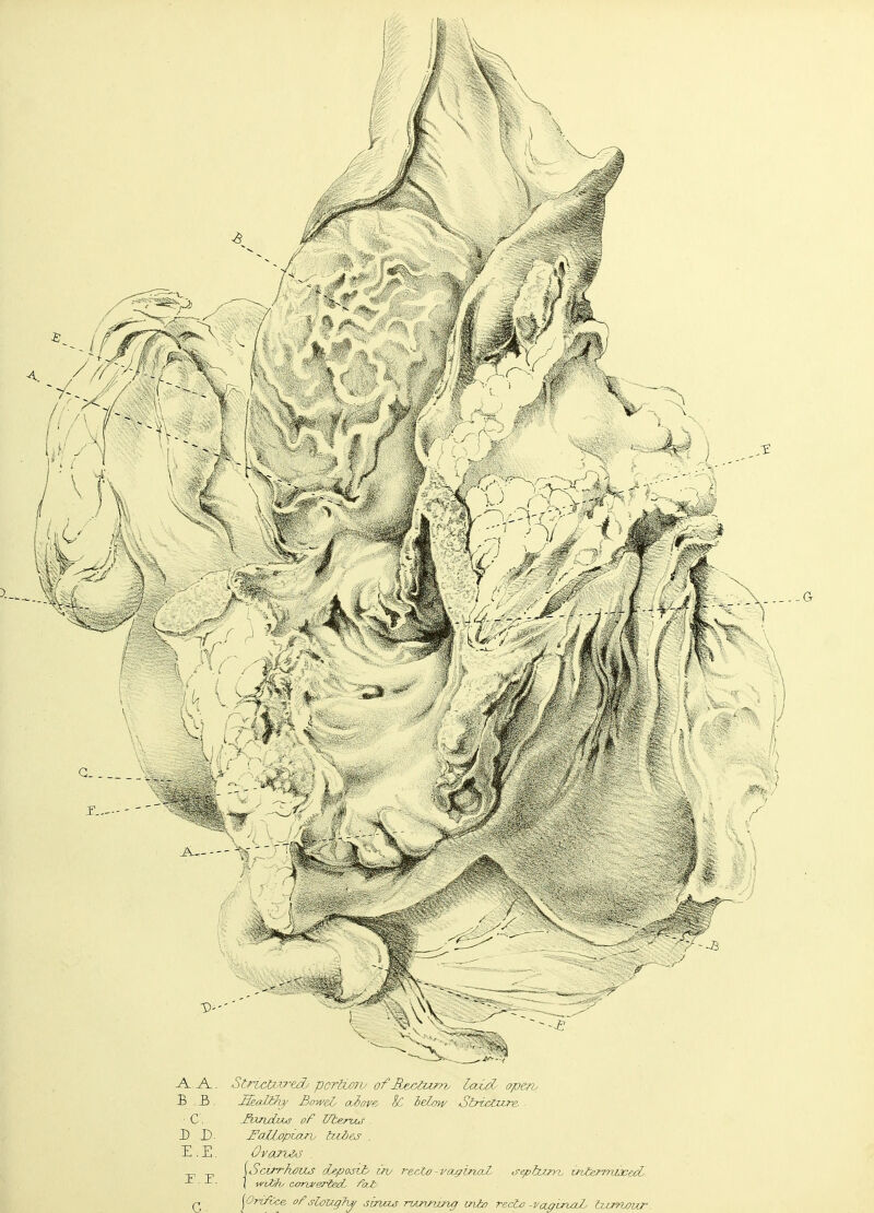 .A.A.. StnctvTtdy portion/ of Re£&im/ LaidO open, B . 3. Hcafcky BoweL oubove %C below Stricture. ■ ■ C IhruLuw of Uberuj . D D. Z'aUj'ptarv bzdts . E. E. Ovaro&s . _ [Scirrhous deposit uv recto-vaginaL septum, intermixed, ■ ( wiZh converted, fat/ „ {Orifice of slougfw sbvzs nmrurtg mto recto -vaniruxL turrwur.