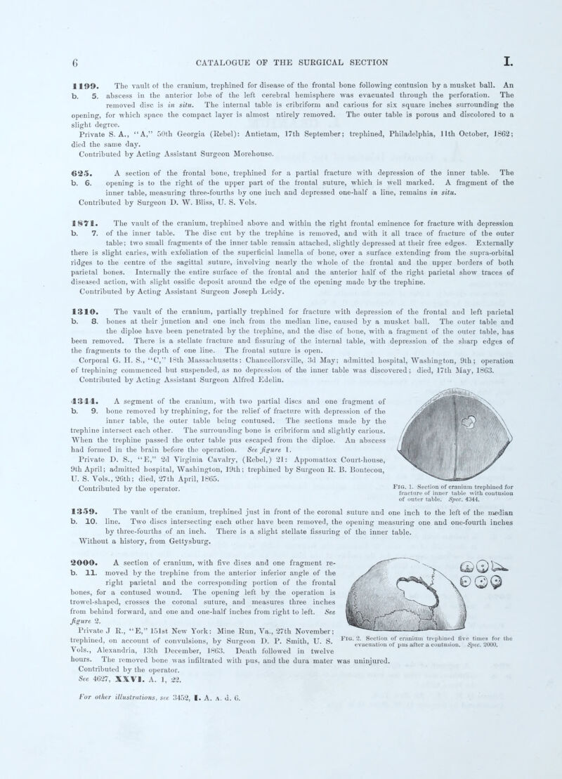 1199. The vault of the cranium, trephined for disease of the frontal bone following contusion by a musket ball. An b. 5. abscess in the anterior lobe of the left cerebral hemisphere was evacuated through the perforation. The removed disc is in situ. The internal table is cribriform and carious for six square inches surrounding the opening, for which space the compact layer is almost ntirely removed. The outer table is porous and discolored to a slight degree. Private S. A., A, 50th Georgia (Eebel): Antietam, 17th September; trephined, Philadelphia, llth October, J862; died the same day. Contributed by Acting Assistant Surgeon Morehouse. 625. A section of the frontal bone, trephined for a partial fracture with depression of the inner table. The b. 6. opening is to the right of the upper part of the frontal suture, which is well marked. A fragment of the inner table, measuring three-fourths by one inch and depressed one-half a line, remains in situ. Contributed by Surgeon D. W. Bliss, U. S. Vols. 1§71. The vault of the cranium, trephined above and within the right frontal eminence for fracture with depression b. 7. of the inner table. The disc cut by the trephine is removed, and with it all trace of fracture of the outer table; two small fragments of the inner table remain attached, slightly depressed at their free edges. Externally there is slight caries, with exfoliation of the superficial lamella of bone, over a surface extending from the supra-orbital ridges to the centre of the sagittal suture, involving nearly the whole of the frontal and the upper borders of both parietal bones. Internally the entire surface of the frontal and the anterior half of the right parietal show traces of diseased action, with slight ossitic deposit around the edge of the opening made by the trephine. Contributed by Acting Assistant Surgeon Joseph Leidy. 1310. The vault of the cranium, partially trephined for fracture with depression of the frontal and left parietal b. 8. bones at their junction and one inch from the median line, caused by a musket ball. The outer table and the diploe have been penetrated by the trephine, and the disc of bone, with a fragment of the outer table, has been removed. There is a stellate fracture and Assuring of the internal table, with depression of the sharp edges of the fragments to the depth of one line. The frontal suture is open. Corporal G. H. S., C, 18th Massachusetts: Chancellorsville, 3d May; admitted hospital, Washington, 9th; operation of trephining commenced but suspended, as no depression of the inner table was discovered; died, 17th May, 1863. Contributed by Acting Assistant Surgeon Alfred Edelin. 4344. A segment of the cranium, with two partial discs and one fragment of b. 9. bone removed by trephining, for the relief of fracture with depression of the inner table, the outer table being contused. The sections made by the trephine intersect each other. The surrounding bone is cribriform and slightly carious. When the trephine passed the outer table pus escaped from the diploe. An abscess had formed in the brain before the operation. See figure 1. Private D. S., E, 2d Virginia Cavalry, (Rebel,) 21: Appomattox Court-house, 9th April; admitted hospital, Washington, 19th; trephined by Surgeon R. B. Bontecou, U. S. Vols., 26th; died, 27th April, 1865. Contributed by the operator. 1359. The vault of the cranium, trephined just in front of the coronal suture and one inch to the left b. 10. line. Two discs intersecting each other have been removed, the opening measuring one and one by three-fourths of an inch. There is a slight stellate Assuring of the inner table. Without a history, from Gettysburg. of the median -fourth inches 2000. A section of cranium, with five discs and one fragment re- b. 11. moved by the trephine from the anterior inferior angle of the right parietal and the corresponding portion of the frontal bones, for a contused wound. The opening left by the operation is trowel-shaped, crosses the coronal suture, and measures three inches from behind forward, and one and one-half inches from right to left. See figure 2. Private J R., E, 151st New York: Mine Run, Va., 27th November; trephined, on account of convulsions, by Surgeon D. P. Smith, U. S. FlG'trva,^ Vols., Alexandria, 13th December, 1863. Death followed in twelve hours. The removed bone was infiltrated with pus, and the dura mater was uninjured Contributed by the operator. See 4627, XXVI. A. 1, 22. Q0U For other illustrations, sec 3452, I. A.