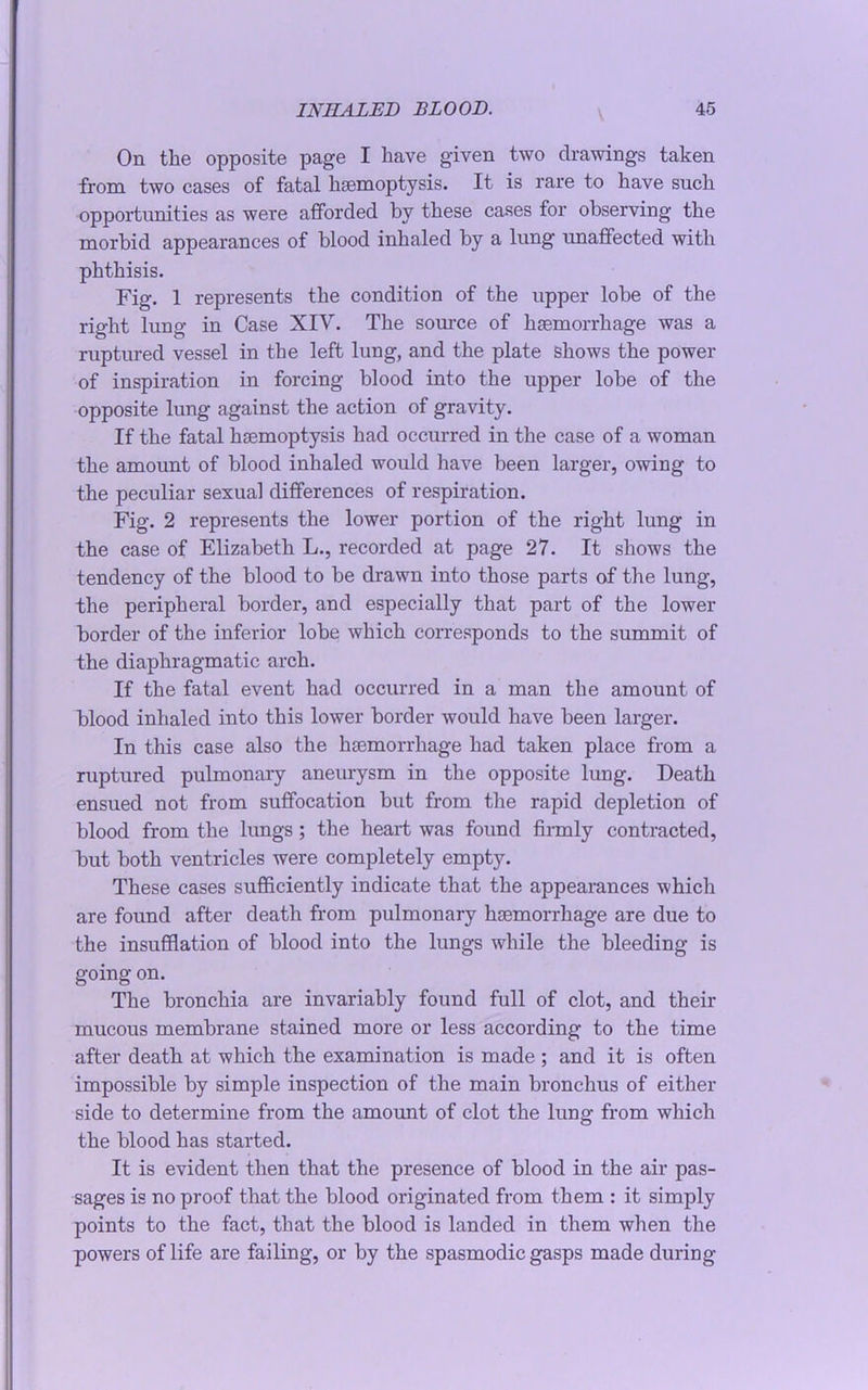 On the opposite page I have given two drawings taken from two cases of fatal haemoptysis. It is rare to have such opportunities as were afforded by these cases for observing the morbid appearances of blood inhaled by a lung unaffected with phthisis. Fig. 1 represents the condition of the upper lobe of the right lung in Case XIV. The source of haemorrhage was a ruptured vessel in the left lung, and the plate shows the power of inspiration in forcing blood into the upper lobe of the opposite lung against the action of gravity. If the fatal haemoptysis had occurred in the case of a woman the amount of blood inhaled would have been larger, owing to the peculiar sexual differences of respiration. Fig. 2 represents the lower portion of the right lung in the case of Elizabeth L., recorded at page 27. It shows the tendency of the blood to be drawn into those parts of the lung, the peripheral border, and especially that part of the lower border of the inferior lobe which corresponds to the summit of the diaphragmatic arch. If the fatal event had occurred in a man the amount of blood inhaled into this lower border would have been larger. In this case also the haemorrhage had taken place from a ruptured pulmonary aneurysm in the opposite lung. Death ensued not from suffocation but from the rapid depletion of blood from the lungs ; the heart was found firmly contracted, but both ventricles were completely empty. These cases sufficiently indicate that the appearances which are found after death from pulmonary haemorrhage are due to the insufflation of blood into the lungs while the bleeding is going on. The bronchia are invariably found full of clot, and their mucous membrane stained more or less according to the time after death at which the examination is made ; and it is often impossible by simple inspection of the main bronchus of either side to determine from the amount of clot the lung from which the blood has started. It is evident then that the presence of blood in the air pas- sages is no proof that the blood originated from them : it simply points to the fact, that the blood is landed in them when the powers of life are failing, or by the spasmodic gasps made during