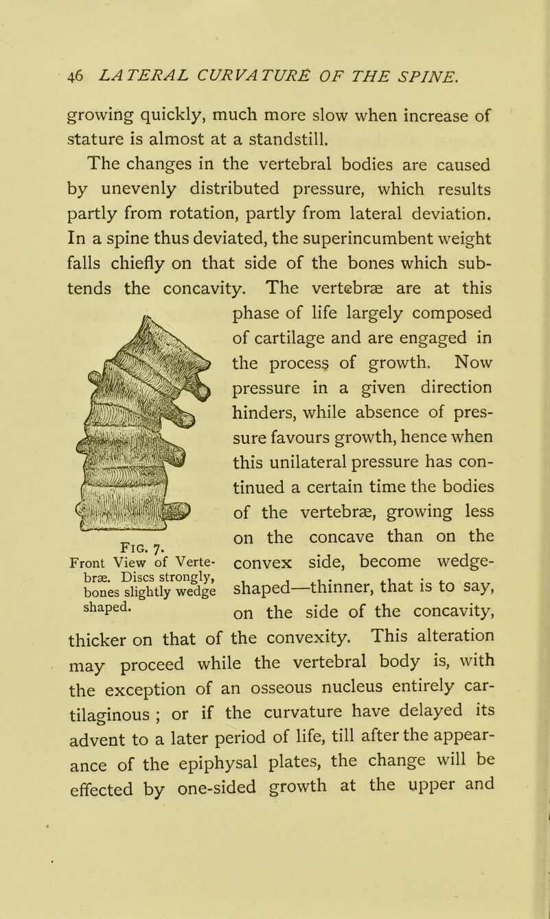 growing quickly, much more slow when increase of stature is almost at a standstill. The changes in the vertebral bodies are caused by unevenly distributed pressure, which results partly from rotation, partly from lateral deviation. In a spine thus deviated, the superincumbent weight falls chiefly on that side of the bones which sub- tends the concavity. The vertebrae are at this phase of life largely composed of cartilage and are engaged in the process of growth. Now pressure in a given direction hinders, while absence of pres- sure favours growth, hence when this unilateral pressure has con- tinued a certain time the bodies of the vertebrae, growing less on the concave than on the convex side, become wedge- shaped—thinner, that is to say, on the side of the concavity, thicker on that of the convexity. This alteration may proceed while the vertebral body is, with the exception of an osseous nucleus entirely car- tilaginous ; or if the curvature have delayed its advent to a later period of life, till after the appear- ance of the epiphysal plates, the change will be effected by one-sided growth at the upper and Fig. 7. Front View of Verte- brae. Discs strongly, bones slightly wedge shaped.