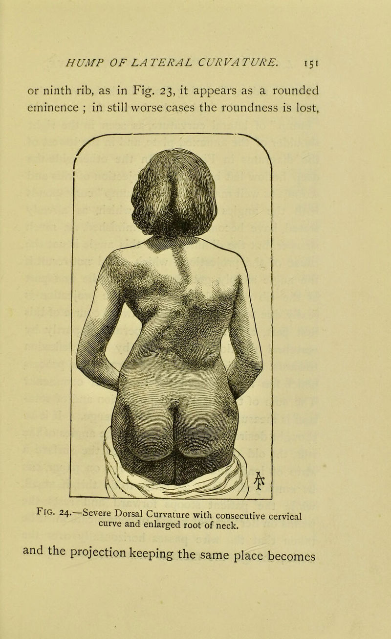 HUMP OF LATERAL CURVATURE, or ninth rib, as in Fig. 23, it appears as a rounded eminence ; in still worse cases the roundness is lost, Fig. 24.—Severe Dorsal Curvature with consecutive cervical curve and enlarged root of neck. and the projection keeping the same place becomes