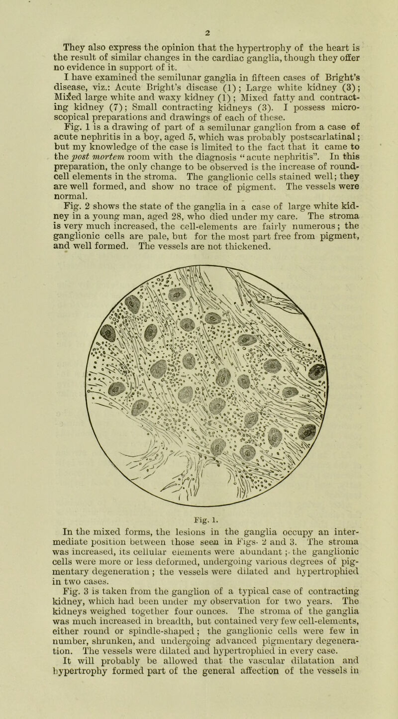 They also express the opinion that the hypertrophy of the heart is the result of similar changes in the cardiac ganglia, though they offer no evidence in support of it. I have examined the semilunar ganglia in fifteen cases of Bright’s disease, viz.: Acute Bright’s disease (1); Large white kidney (3); Mi^ed large white and waxy kidney (1) ; Mixed fatty and contract- ing kidney (7); Small contracting kidneys (3). I possess micro- scopical preparations and drawings of each of these. Fig. 1 is a drawing of part of a semilunar ganglion from a case of acute nephritis in a boy, aged 5, which was probably postscarlatinal; but my knowledge of the case is limited to the fact that it came to the post mortem room with the diagnosis “ acute nephritis”. In this preparation, the only change to be observed is the increase of round- cell elements in the stroma. The ganglionic cells stained well; they are well formed, and show no trace of pigment. The vessels were normal. Fig. 2 shows the state of the ganglia in a case of large white kid- ney in a young man, aged 28, who died under my care. The stroma is very much increased, the cell-elements are fairly numerous; the ganglionic cells are pale, but for the most part free from pigment, and well formed. The vessels are not thickened. Fig. 1. In the mixed forms, the lesions in the ganglia occupy an inter- mediate position between those seen in Figs- 2 and 3. The stroma was increased, its ceiluiar elements were abundant ;• the ganglionic cells were more or less deformed, undergoing various degrees of pig- mentary degeneration ; the vessels were dilated and hypertrophied in two cases. Fig. 3 is taken from the ganglion of a typical case of contracting- kidney, which had been under my observation for two years. The kidneys weighed together four ounces. The stroma of the ganglia was much increased in breadth, but contained very few cell-elements, either round or spindle-shaped ; the ganghonic cells were few in number, shrunken, and undergoing advanced pigmentary degenera- tion. The vessels were dilated and hypertrophied in every case. It will probably be allowed that the vascular dilatation and hypertrophy formed part of the general affection of the vessels in