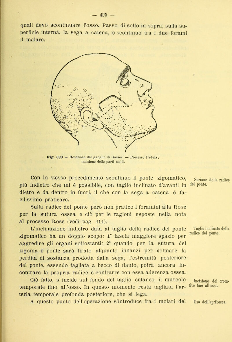 quali devo scontinuare l'osso. Passo di sotto in sopra, sulla su- perfìcie interna, la sega a catena, e scontinuo tra i due forami il malare. Fig. 393 — Resezione del ganglio di Gasser. — Processo Padula; incisione delle parti molli. Con lo stesso procedimento scontinuo il ponte zigomatico, Seziono della radice più indietro che mi è possibile, con taglio inclinato d'avanti in po'^te. dietro e da dentro in fuori, il che con la sega a catena è fa- cilissimo praticare. Sulla radice del ponte però non pratico i foramini alla Rose per la sutura ossea e ciò per le ragioni esposte nella nota al processo Rose (vedi pag. 414). L'inclinazione indietro data al taglio della radice del ponte Taglio inclinato della ,. , , . ^01- • • radico del ponte. Zigomatico ha un doppio scopo: 1 lascia maggiore spazio per aggredire gli organi sottostanti; 2' quando per la sutura del zigoma il ponte sarà tirato alquanto innanzi per colmare la perdita di sostanza prodotta dalla sega, l'estremità posteriore del ponte, essendo tagliata a becco di flauto, potrà ancora in- contrare la propria radice e contrarre con essa aderenza ossea. Ciò fatto, s'incide sul fondo del taglio cutaneo il muscolo incisione del crota- temporale fino all'osso. In questo momento resta tagliata l'ar- all'osso, feria temporale profonda posteriore, che si lega. A questo punto dell'operazione s'introduce fra i molari del Uso deirapribocca.