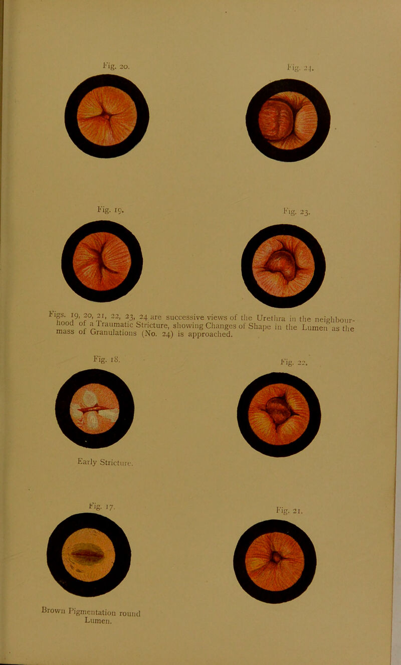 Fig. 19. Fig. 23. tigs. 19, 20, 2i, 22, 23, 24 are successive views of the Urethra in the neiehbour- rau,matlc Stricture, showing Changes of Shape in the Lumen as the mass of Granulations (No. 24) is approached. Fig. itJ. Early Stricture. Fig. 17. Brown Pigmentation round Lumen. Fig. 21. * v:r 1