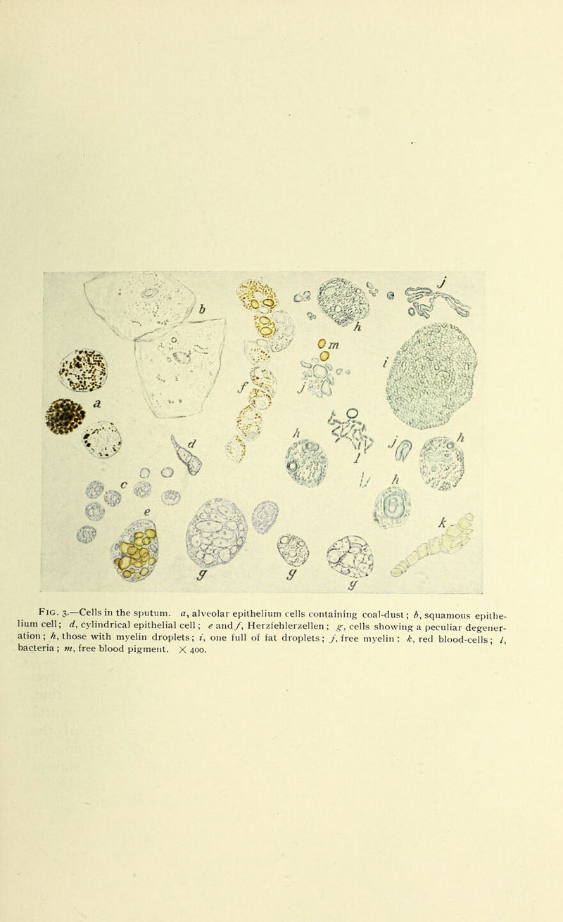 Ojn U Fig. 3.—Cells in the sputum, a, alveolar epithelium cells containing coal-dust; squamous epithe- lium cell; d, cylindrical epithelial cell; e and/, Herzfehlerzellen ; g-, cells showing a peculiar degener- ation those with myelin droplets; one full of fat droplets; 7, free myelin; k, red blood-cells; /, bacteria; free blood pigment. X 400.