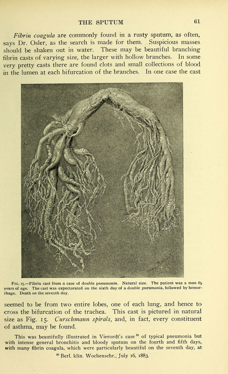 Fibrin coagula are commonly found in a rusty sputum, as often, says Dr. Osier, as the search is made for them. Suspicious masses should be shaken out in water. These may be beautiful branching fibrin casts of varying size, the larger with hollow branches. In some. very pretty casts there are found clots and small collections of blood in the lumen at each bifurcation of the branches. In one case the cast Fig. 15.—Fibrin cast from a case of double pneumonia. Natural size. The patient was a man 65 years of age. The cast was expectorated on the sixth day of a double pneumonia, followed by hemor- rhage. Death on the seventh day. seemed to be from two entire lobes, one of each lung, and hence to cross the bifurcation of the trachea. This cast is pictured in natural size as Fig. 15. Curschmann spirals, and, in fact, every constituent of asthma, may be found. This was beautifully illustrated in Vierordt's case of typical pneumonia but with intense general bronchitis and bloody sputum on the fourth and fifth days, with many fibrin coagula, which were particularly beautiful on the seventh day, at Berl. klin. Wochenschr., July 16, 1883.