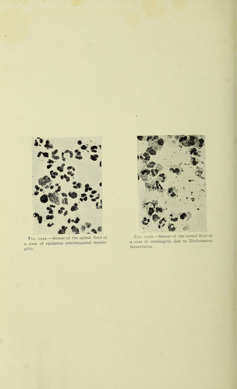 Fig. I2 2C.—Smear of the spinal fluid of a case of epidemic cerebrospinal menin- gitis. Fig. i22d.—Smear of the spmal fluid of a case of meningitis due to Diplococcus lanceolatus.