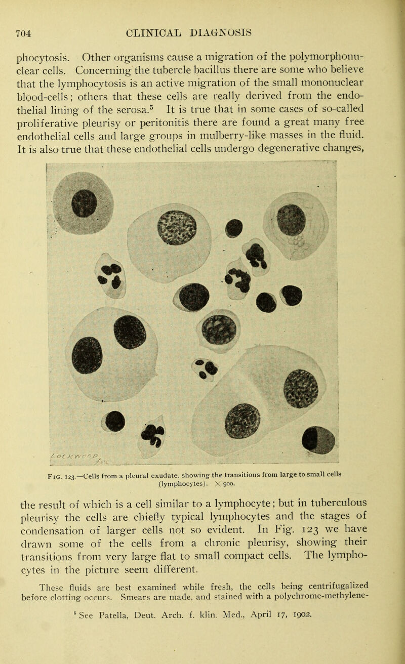 phocytosis. Other organisms cause a migration of the polymorphonu- clear cells. Concerning the tubercle bacillus there are some who believe that the lymphocytosis is an active migration of the small mononuclear blood-cells; others that these cells are really derived from the endo- thelial lining of the serosa.^ It is true that in some cases of so-called proliferative pleurisy or peritonitis there are found a great many free endothelial cells and large groups in mulberry-like masses in the fluid. It is also true that these endothelial cells undergo degenerative changes, Fig. 123.—Cells from a pleural exudate, showing the transitions from large to small cells (lymphocytes). X 900. the result of which is a cell similar to a lymphocyte; but in tuberculous pleurisy the cells are chiefly typical lymphocytes and the stages of condensation of larger cells not so evident. In Fig. 123 we have drawn some of the cells from a chronic pleurisy, showing their transitions from very large flat to small compact cells. The lympho- cytes in the picture seem different. These fluids are best examined while fresh, the cells being centrifugalized before clotting occin-s. Smears are made, and stained with a polychrome-methylene- VSee Patella, Dent. Arch. f. klin. Med., April 17, 1902.