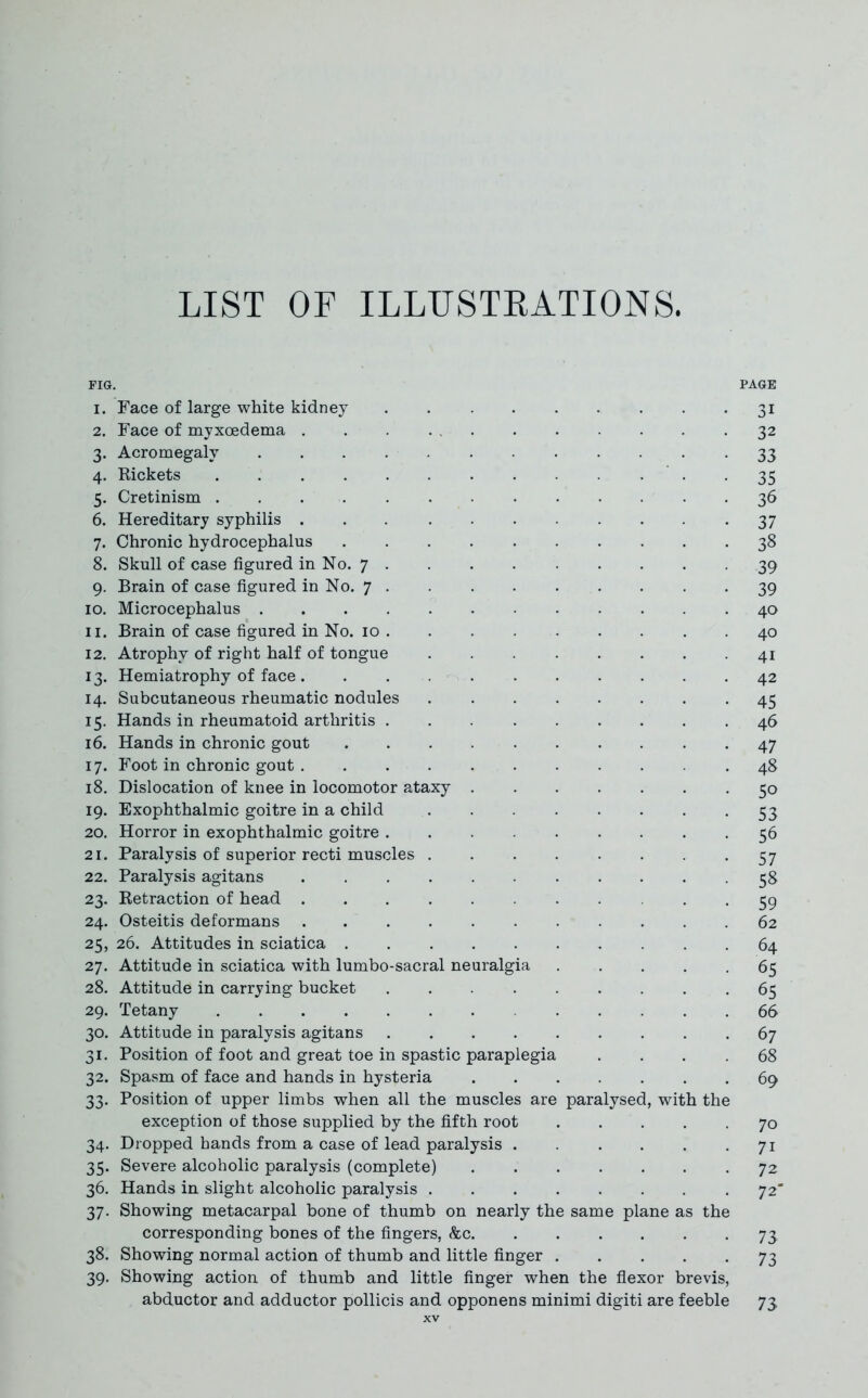 LIST OF ILLUSTRATIONS. FIG. PAGE 1. Face of large white kidney 31 2. Face of myxoedema 32 3. Acromegaly ............ 33 4. Rickets . • • • • 35 5. Cretinism 36 6. Hereditary syphilis 37 7. Chronic hydrocephalus 38 8. Skull of case figured in No. 7 39 9. Brain of case figured in No. 7 . . -39 10. Microcephalus .40 11. Brain of case figured in No. 10. . . . . . . . .40 12. Atrophy of right half of tongue 41 13. Hemiatrophy of face. 42 14. Subcutaneous rheumatic nodules 45 15. Hands in rheumatoid arthritis 46 16. Hands in chronic gout 47 17. Foot in chronic gout ........... 48 18. Dislocation of knee in locomotor ataxy 50 19. Exophthalmic goitre in a child 53 20. Horror in exophthalmic goitre 56 21. Paralysis of superior recti muscles 57 22. Paralysis agitans ........... 58 23. Retraction of head 59 24. Osteitis deformans . 62 25. 26. Attitudes in sciatica . 64 27. Attitude in sciatica with lumbo-sacral neuralgia 65 28. Attitude in carrying bucket ......... 65 29. Tetany 66 30. Attitude in paralysis agitans 67 31. Position of foot and great toe in spastic paraplegia .... 68 32. Spasm of face and hands in hysteria 69 33. Position of upper limbs when all the muscles are paralysed, with the exception of those supplied by the fifth root 70 34. Dropped hands from a case of lead paralysis 71 35. Severe alcoholic paralysis (complete) -72 36. Hands in slight alcoholic paralysis 72' 37. Showing metacarpal bone of thumb on nearly the same plane as the corresponding bones of the fingers, &c 73 38. Showing normal action of thumb and little finger 73 39. Showing action of thumb and little finger when the flexor brevis, abductor and adductor pollicis and opponens minimi digiti are feeble 73