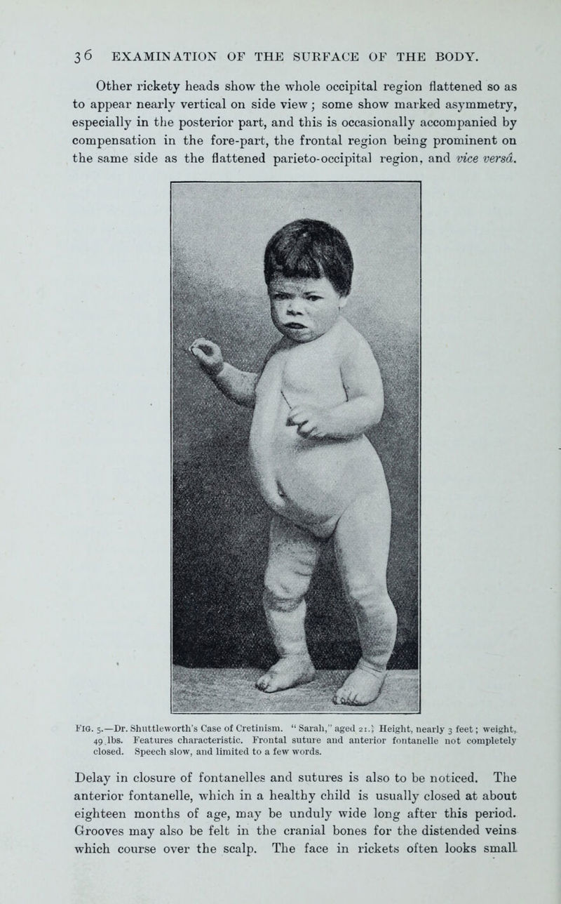 Other rickety heads show the whole occipital region flattened so as to appear nearly vertical on side view; some show marked asymmetry, especially in the posterior part, and this is occasionally accompanied by compensation in the fore-part, the frontal region being prominent on the same side as the flattened parieto-occipital region, and vice versa. I'IG. 5.—Dr. Shuttleworth's Case of Cretinism.  Sarah, aged 21.;: Height, nearly 3 feet; weight, 49.lbs. Features characteristic. Frontal suture and anterior fontanelle not completely closed. Speech slow, and limited to a few words. Delay in closure of fontanelles and sutures is also to be noticed. The anterior fontanelle, which in a healthy child is usually closed at about eighteen months of age, may be unduly wide long after this period. Grooves may also be felt in the cranial bones for the distended veins which course over the scalp. The face in rickets often looks small