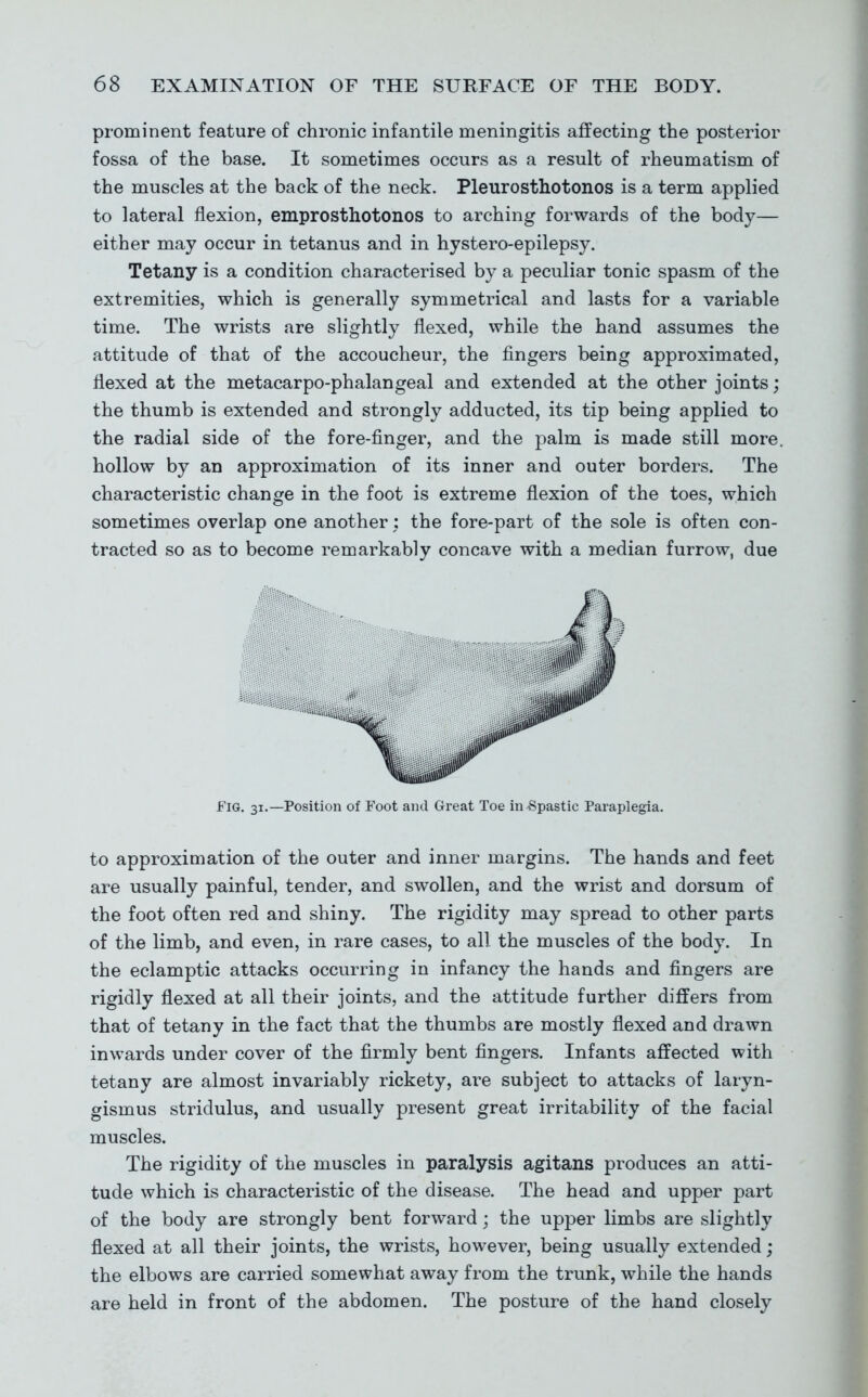 prominent feature of chronic infantile meningitis affecting the posterior fossa of the base. It sometimes occurs as a result of rheumatism of the muscles at the back of the neck. Pleurosthotonos is a term applied to lateral flexion, emprosthotonos to arching forwards of the body— either may occur in tetanus and in hystero-epilepsy. Tetany is a condition characterised by a peculiar tonic spasm of the extremities, which is generally symmetrical and lasts for a variable time. The wrists are slightly flexed, while the hand assumes the attitude of that of the accoucheur, the fingers being approximated, flexed at the metacarpo-phalangeal and extended at the other joints; the thumb is extended and strongly adducted, its tip being applied to the radial side of the fore-finger, and the palm is made still more, hollow by an approximation of its inner and outer borders. The characteristic change in the foot is extreme flexion of the toes, which sometimes overlap one another; the fore-part of the sole is often con- tracted so as to become remarkably concave with a median furrow, due Fig. 31.—Position of Foot and Great Toe in^Spastic Paraplegia. to approximation of the outer and inner margins. The hands and feet are usually painful, tender, and swollen, and the wrist and dorsum of the foot often red and shiny. The rigidity may spread to other parts of the limb, and even, in rare cases, to all the muscles of the body. In the eclamptic attacks occurring in infancy the hands and fingers are rigidly flexed at all their joints, and the attitude further differs from that of tetany in the fact that the thumbs are mostly flexed and drawn inwards under cover of the firmly bent fingers. Infants affected with tetany are almost invariably rickety, are subject to attacks of laryn- gismus stridulus, and usually present great irritability of the facial muscles. The rigidity of the muscles in paralysis agitans produces an atti- tude which is characteristic of the disease. The head and upper part of the body are strongly bent forward; the upper limbs are slightly flexed at all their joints, the wrists, however, being usually extended; the elbows are carried somewhat away from the trunk, while the hands are held in front of the abdomen. The posture of the hand closely