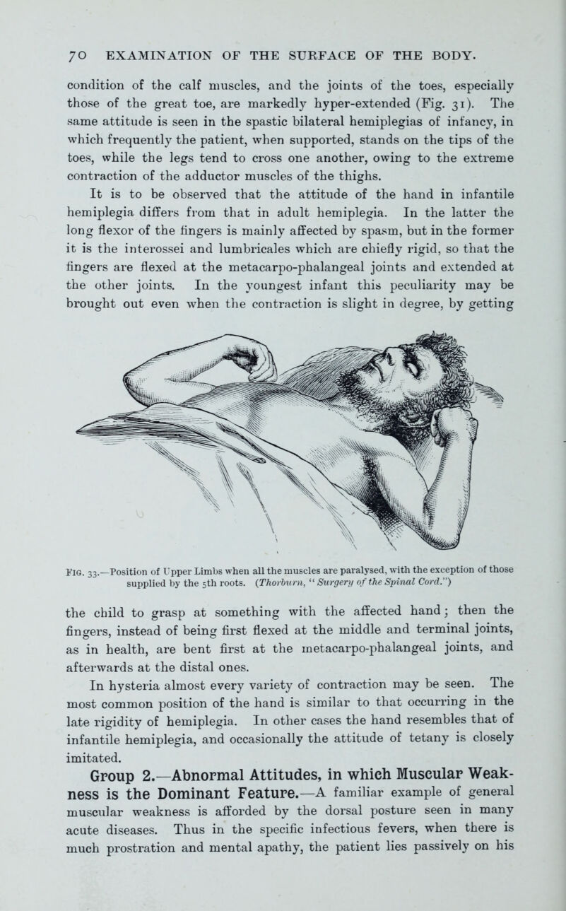 condition of the calf muscles, and the joints of the toes, especially those of the great toe, are markedly hyper-extended (Fig. 31). The same attitude is seen in the spastic bilateral hemiplegias of infancy, in which frequently the patient, when supported, stands on the tips of the toes, while the legs tend to cross one another, owing to the extreme contraction of the adductor muscles of the thighs. It is to be observed that the attitude of the hand in infantile hemiplegia differs from that in adult hemiplegia. In the latter the long flexor of the lingers is mainly affected by spasm, but in the former it is the interossei and lumbricales which are chiefly rigid, so that the fingers are flexed at the metacarpo-phalangeal joints and extended at the other joints. In the youngest infant this peculiarity may be brought out even when the contraction is slight in degree, by getting j'iG. 33.—Position of Upper Limbs when all the muscles are paralysed, with the exception of those supplied by the 5th roots. {Thorburn,  Surgery of the Spinal Cord.) the child to grasp at something with the affected hand; then the fingers, instead of being first flexed at the middle and terminal joints, as in health, are bent first at the metacarpo-phalangeal joints, and afterwards at the distal ones. In hysteria almost every variety of contraction may be seen. The most common position of the hand is similar to that occurring in the late rigidity of hemiplegia. In other cases the hand resembles that of infantile hemiplegia, and occasionally the attitude of tetany is closely imitated. Group 2.—Abnormal Attitudes, in which Muscular Weak- ness is the Dominant Feature.—A familiar example of general muscular weakness is afforded by the dorsal posture seen in many acute diseases. Thus in the specific infectious fevers, when there is much prostration and mental apathy, the patient lies passively on his