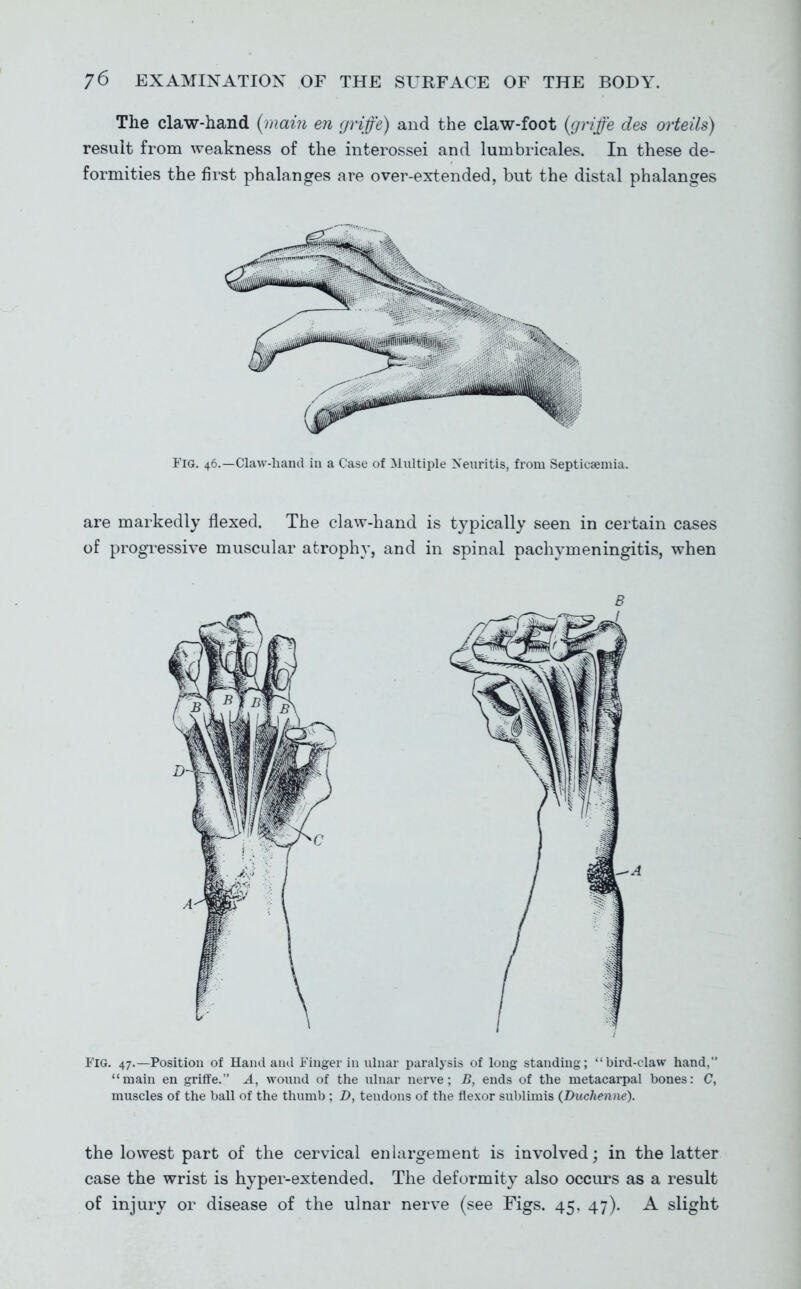 The claw-hand {main en grife) and the claw-foot (gnfe des orteils) result from weakness of the interossei and lumbricales. In these de- formities the first phalanges are over-extended, but the distal phalanges Fig. 46.—Claw-hand in a Case of Multiple Xeuritis, from Septicaemia. are markedly flexed. The claw-hand is typically seen in certain cases of progressive muscular atrophy, and in spinal pachymeningitis, when Fig. 47.—Position of Hand and Finger in ulnar paralysis of long standing; bird-claw hand, main en griffe. A, wound of the ulnar nerve; B, ends of the metacarpal bones: C, muscles of the ball of the thumb ; D, tendons of the flexor sublimis (Duchenne). the lowest part of the cervical enlargement is involved; in the latter case the wrist is hyper-extended. The deformity also occurs as a result of injury or disease of the ulnar nerve (see Figs. 45, 47). A slight