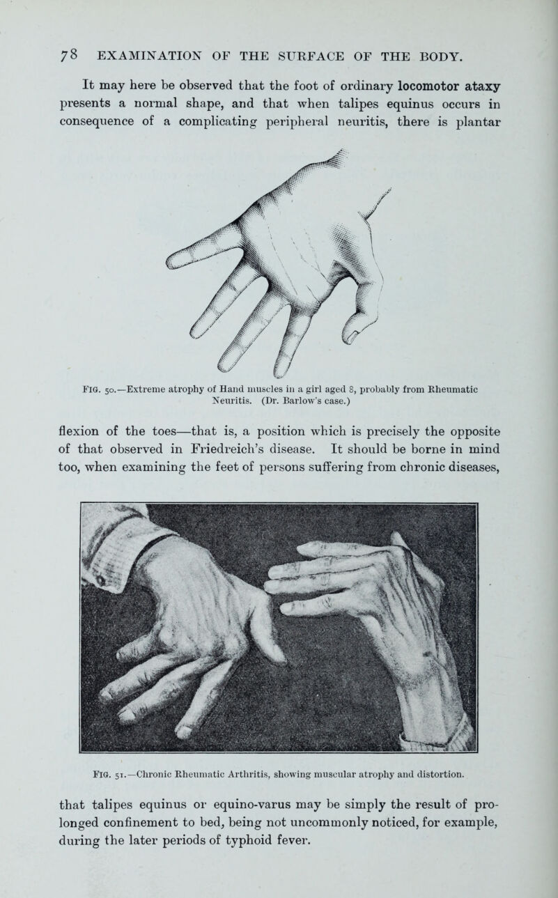 It may here be observed that the foot of ordinary locomotor ataxy- presents a normal shape, and that when talipes equinus occurs in consequence of a complicating peripheral neuritis, there is plantar Fig. 50.—Extreme atrophy of Hand muscles 111 a gui aged 8, probably from Rheumatic Neuritis. (Dr. Barlow's case.) flexion of the toes—that is, a position which is precisely the opposite of that observed in Friedreich's disease. It should be borne in mind too, when examining the feet of persons suffering from chronic diseases, Fig. 51.—Chronic Eheumatic Arthritis, showing muscular atrophy and distortion. that talipes equinus or equino-varus may be simply the result of pro- longed confinement to bed, being not uncommonly noticed, for example, during the later periods of typhoid fever.