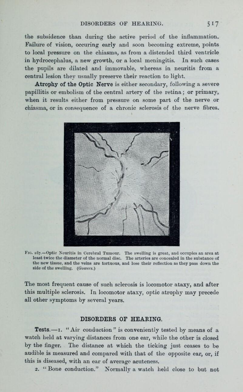 the subsidence than during the active period of the inflammation. Failure of vision, occuring early and soon becoming extreme, points to local pressure on the chiasma, as from a distended third ventricle in hydrocephalus, a new growth, or a local meningitis. In such cases the pupils are dilated and immovable, whereas in neuritis from a central lesion they usually preserve their reaction to light. Atrophy of the Optic Nerve is either secondary, following a severe papillitis or embolism of the central artery of the retina; or primary, when it results either from pressure on some part of the nerve or chiasma, or in consequence of a chronic sclerosis of the nerve fibres. Fig. 287.—Optic Neuritis in Cerebral Tumour. The swelling is great, and occupies an area at least twice the diameter of the normal disc. The arteries are concealed in the substance of the new tissue, and the veins are tortuous, and lose their reflection as they pass down the side of the swelling. (Gowers.) The most frequent cause of such sclerosis is locomotor ataxy, and after this multiple sclerosis. In locomotor ataxy, optic atrophy may precede all other symptoms by several years. DISORDERS OF HEARING. Tests.—I. Air conduction is conveniently tested by means of a watch held at varying distances from one ear, while the other is closed by the finger. The distance at which the ticking just ceases to be audible is measured and compared with that of the opposite ear, or, if this is diseased, with an ear of average acuteness.