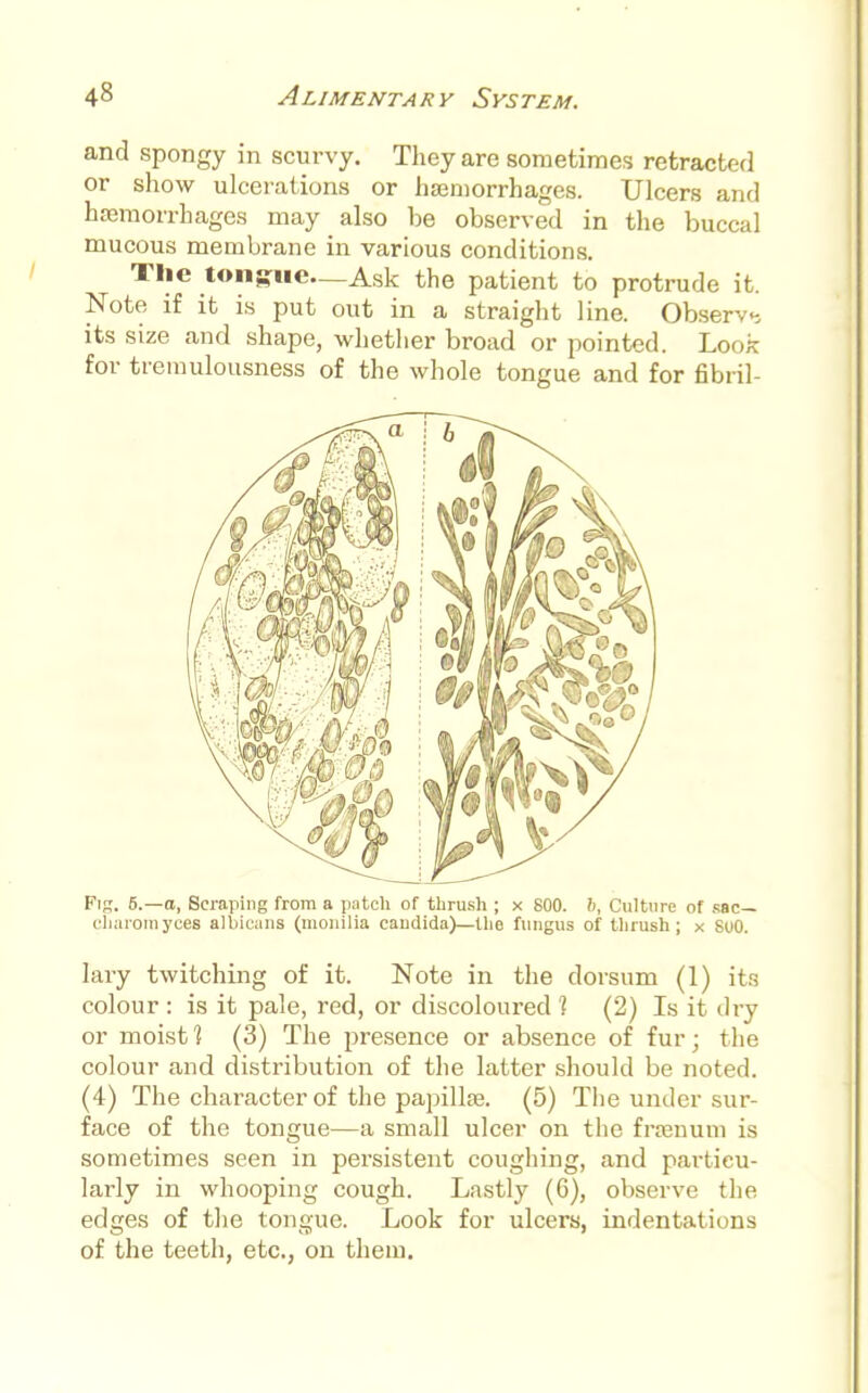 and spongy in scurvy. They are sometimes retracted or show ulcerations or haemorrhages. Ulcers and haemorrhages may also he observed in the buccal mucous membrane in various conditions. The tongue—Ask the patient to protrude it. Note if it is put out in a straight line. Observe its size and shape, whether broad or pointed. Look for tremulousness of the whole tongue and for fibril- Fig. 6.—o, Scraping from a patch of thrush ; x 800. 6, Culture of sac— cliaromyces albicans (monilia Candida)—the fungus of thrush; x SuO. lary twitching of it. Note in the dorsum (1) its colour : is it pale, red, or discoloured 1 (2) Is it dry or moist ] (3) The presence or absence of fur; the colour and distribution of the latter should be noted. (4) The character of the papilla?. (5) The under sur- face of the tongue—a small ulcer on the fraenum is sometimes seen in persistent coughing, and particu- larly in whooping cough. Lastly (6), observe the edges of the tongue. Look for ulcers, indentations of the teeth, etc., on them.