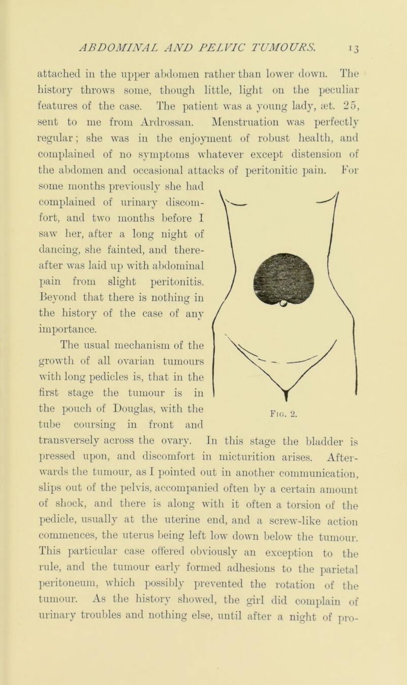 attached in the up})er ahduineu ratlier than lower down. 1'he history throws some, though little, liglit on tJie peculiar features of the case. The patient was a young lady, iet. 25, sent to me from Ardrossan. INIenstruation was perfectl}' regular; she was in the enjoyment of robust healtli, and complained of no symptoms whatever except distension of the abdomen and occasional attacks of peritonitic pain. For some months previ(jusly she had complained of urinary discom- fort, and two mouths Ijefore I saw her, after a long night of dancing, she fainted, and there- after was laid u}) with abdominal l)ain from slight peritonitis, llevond that there is nothincr in the history of the case of any importance. The usual mechanism of the growth of all ovarian tumours witli long pedicles is, that in the first stage the tumour is in the pouch of Douglas, with the tulje coursino; in front and transversely across the ovary. In this stage the bladder is pressed upon, and discomfort in micturition arises. After- wards the tumour, as I pointed out in another communication, slips out of the pelvis, accompanied often by a certain amount of shock, and tliere is along with it often a torsion of tlie pedicle, usually at the uterine end, and a screw-like action commences, the uterus being left low down below tlie tumour. Fir;. 2. This particular case ofiered obviously an exception to the rule, and tlie tumour early formed adhesions to tlie parietal peritoneum, which possilily prevented tlie rotation of the tumour. As the history showed, the girl did complain of urinary troubles and nothing else, until after a night of ]iro-