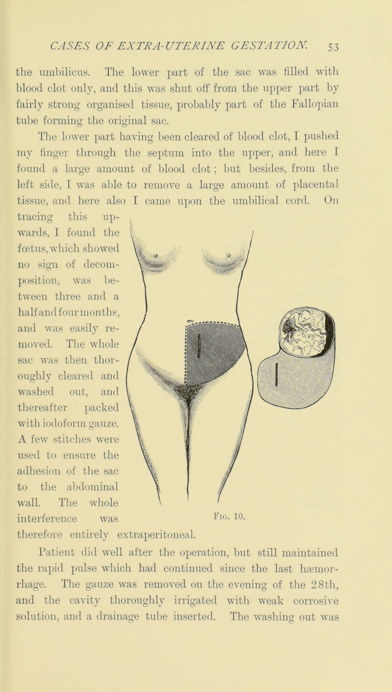 the umbilicus. The lower part of the sac was filled with l)lood clot only, and this was shut off from the upper part by fairly strong organised tissue, probably part of the Fallopian tube forming the original sac. The lower part having lieen cleared of blood clot, I pushed my finger through the septum into the upper, and here 1 found a large amount of Idood clot; but besides, from the left side, I was able to remove a large amount of placental tissue, and here also I came upon the umbilical cord. On tracing this up- wards, I found the foetus, wdiich showed no sign of decom- position, was be- tween three and a halfand four months, and was easily re- moved. The whole sac was then thor- oughly cleared and washed out, and thereafter packed with iodoform gauze. A few stitches were used to ensure the adhesion of the sac to the al.xlominal wall. The whole interference was therefore entirely extraperitoneal. Fatient did well after tlie operation, but still maintained the rapid pidse which had continued since the last luemor- rhage. The gauze was removed on tlie evening of the 28th, and the cavity thorougidy irrigated witli weak corrosive solution, and a drainage tulje inserted. The washing out was Fkj. 10.