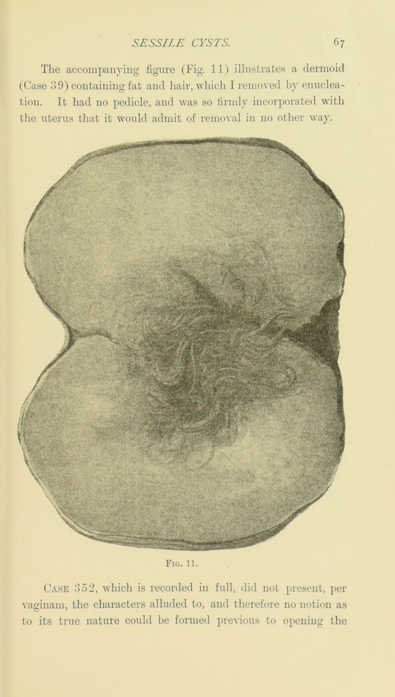 The accompanying figure (Fig. 11) illnstrates a dermoid (Case 39) containing fat and hair, yhicli I removed b}' enuclea- tion. It had no pedicle, and vas so firndv incorporated with the uterus tliat it would admit of removal in no otlier way. Fig. 11. Case 352, which is recorded in full, did not present, per vagiuam, the characters alluded to, and therefore no notion as to its true nature could be formed previous to opening the