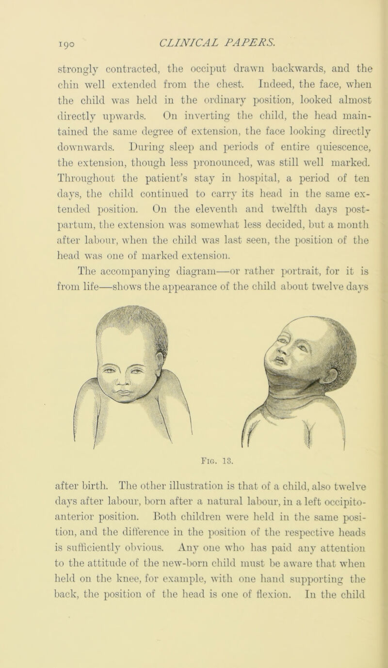 strongly contracted, the occiput drawn backwards, and the chin well extended from the chest. Indeed, the face, wlien the child was held in the ordinary position, looked almost directly upwards. On inverting tlie child, the head main- tained the same degree of extension, the face looking directly downwards. During sleep and periods of entire quiescence, the extension, though less pronounced, was still well marked. Throughout the patient’s stay in hospital, a period of ten days, the child continued to carry its head in the same ex- tended p(^sition. On the eleventli and twelfth days post- partum, the extension was somewhat less decided, but a month after labour, when the child was last seen, the position of the liead was one of marked extension. The accompanying diagram—or ratlier portrait, for it is from life—shows the appearance of the child about twelve days Fig. 13. after birth. The other illustration is that of a child, also twelve days after labour, born after a natural labour, in a left occipito- anterior position. Both children were held in the same posi- tion, and the difference in the position of the respective heads is suthciently obvious. Any one who has paid any attention to the attitude of the new-born child must lie aware that when held on tlie knee, for example, with one liand supporting the liack, the position of the head is one of flexion. In the child