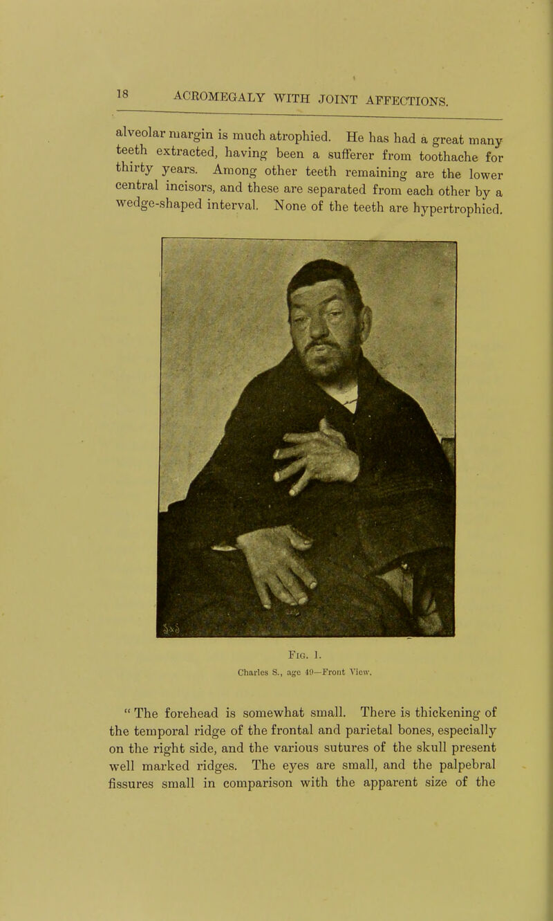 alveolar margin is much atrophied. He has had a great many teeth extracted, having been a sufferer from toothache for thirty years. Among other teeth remaining are the lower central incisors, and these are separated from each other by a wedge-shaped interval. None of the teeth are hypertrophied. Fig. 1. Charles S., age 4!i—Front View.  The forehead is somewhat small. There is thickening of the temporal ridge of the frontal and parietal bones, especially on the right side, and the various sutures of the skull present well marked ridges. The eyes are small, and the palpebral fissures small in comparison with the apparent size of the