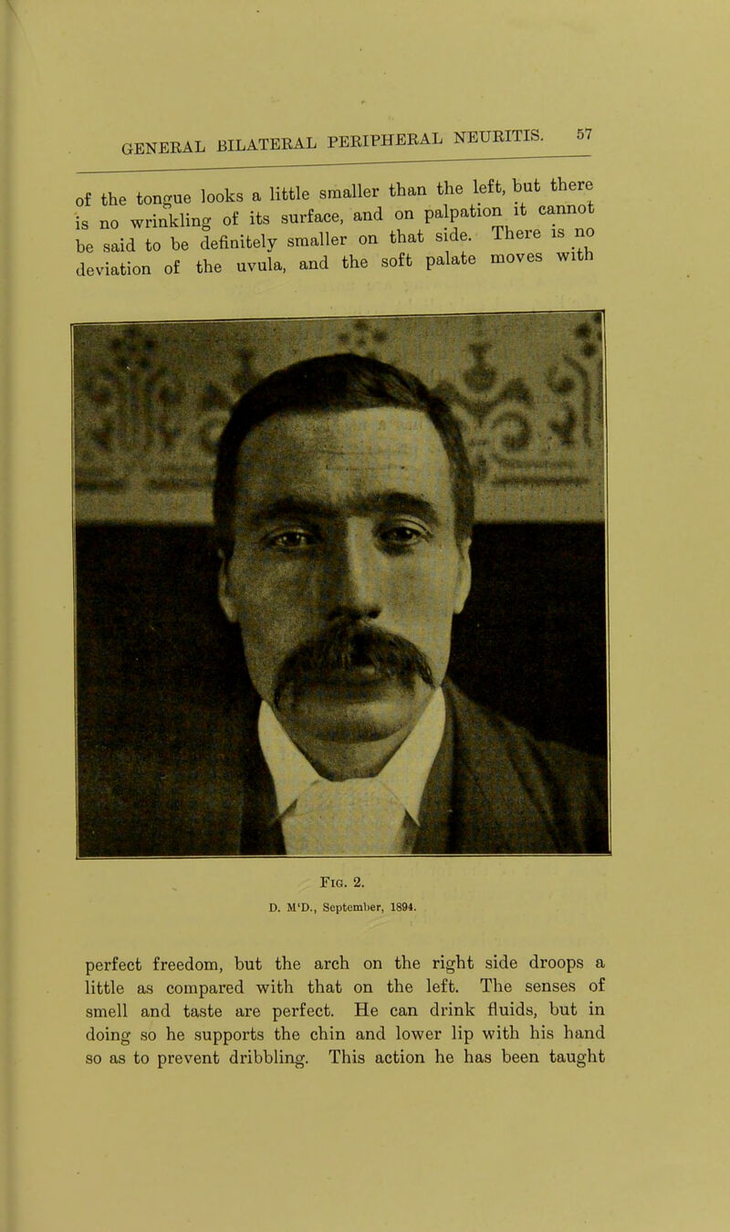 Of the tongue looks a little smaller than the left, but there is no wrinkling of its surface, and on palpation it cannot be said to be definitely smaller on that side. There is no deviation of the uvula, and the soft palate moves with 0 ^ \ Fig. 2. D. M'D., September, 1894. perfect freedom, but the arch on the right side droops a little as compared with that on the left. The senses of smell and taste are perfect. He can drink fluids, but in doing so he supports the chin and lower lip with his hand so as to prevent dribbling. This action he has been taught