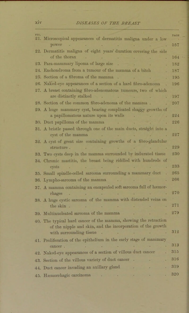 FIG. 21. Microscopical appearances of dermatitis maligna under a low- power ....... 22. Dermatitis maligna of eight years’ duration covering the side of the thorax ...... 23. Para-mammary lipoma of large size .... 24. Enehondroma from a tumour of the mamma of a bitch 25. Section of a fibroma of the mamma .... 26. Naked-eve appearances of a section of a hard fibro-adenoma 27. A breast containing fibro-adenomatous tumours, two of which are distinctly stalked ..... 28. Section of the common fibro-adenoma of the mamma . 29. A huge mammary cyst, bearing complicated shaggy growths of a papillomatous nature upon its walls 30. Duct papilloma of the mamma .... 31. A bristle passed through one of the main ducts, straight into a cyst of the mamma ..... 32. A cyst of great size containing growths of a filno-glandular structure ....... 33. Two cysts deep in the mamma surrounded by indurated tissue 34. Chronic mastitis, the breast being riddled with hundreds of cysts ....... 35. Small spindle-celled sarcoma surrounding a mammary duct . 36. Lympho-sarcoma of the mamma .... 37. A mamma containing an encapsuled soft sarcoma full of hremor- rhages ....... 38. A huge cystic sarcoma of the mamma with distended veins on the skin ....... 39. Multinucleated sarcoma of the mamma 40. The typical haul cancer of the mamma, showing the retraction of the nipple and skin, and the incorporation of the growth with surrounding tissue ..... 41. Proliferation of the epithelium in the early stage of mammary cancer . ...... 42. Naked-eye appearances of a section of villous duct cancer 43. Section of the villous variety of duct cancer . 44. Duct cancer invading an axillary gland 45. Hiemorrhagic carcinoma ..... CAGE 157 164 182 187 195 196 197 207 224 226 227 229 230 233 265 266 270 271 279 312 313 315 316 319 320