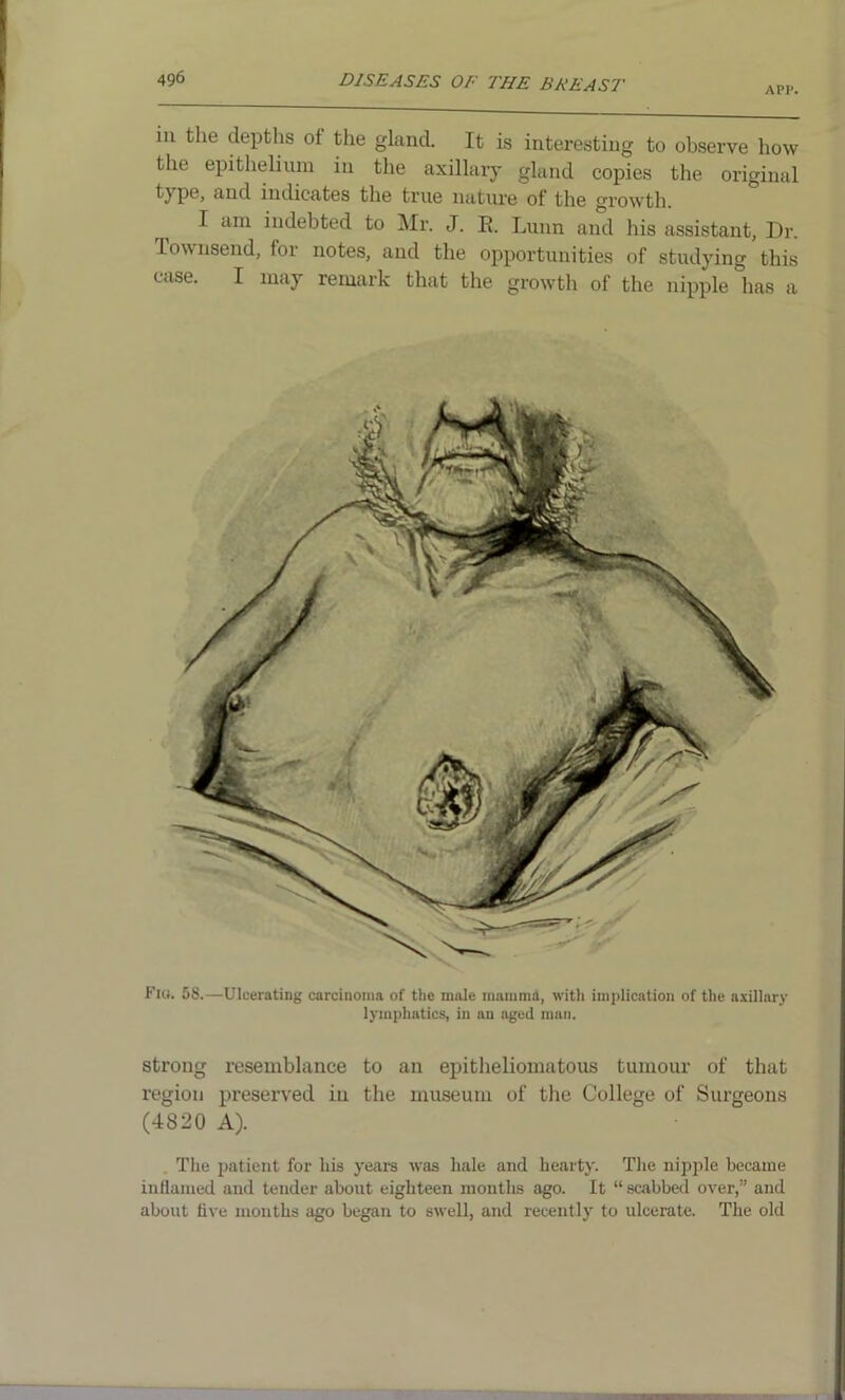 APP. in the depths of the gland. It is interesting to observe how the epithelium in the axillary gland copies the original P®> and indicates the true nature of the growth. I am indebted to Mr. J. R. Lunn and his assistant, Dr. Townsend, for notes, and the opportunities of studying this case. I may remark that the growth of the nipple has a Flo. 58.—Ulcerating carcinoma of the male mamma, with implication of the axillary lymphatics, in an aged man. strong resemblance to an epitheliomatous tumour of that region preserved in the museum of the College of Surgeons (4820 A). The patient for his years was hale and hearty. The nipple became inflamed and tender about eighteen months ago. It “ scabbed over,” and about live months ago began to swell, and recently to ulcerate. The old
