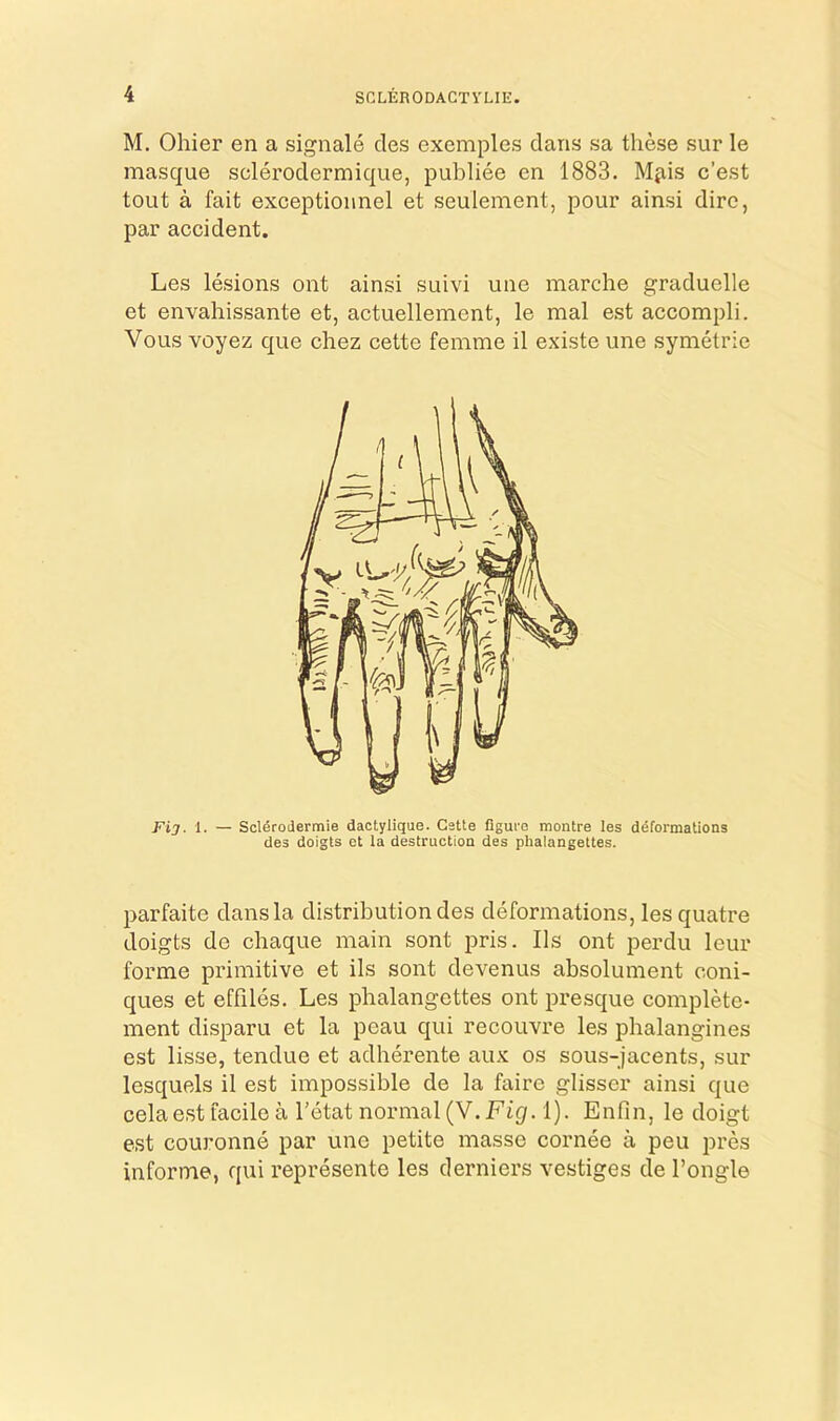 M. Ohier en a signale cles exemples dans sa these sur le masque sclerodermique, publiee en 1883. Mjiis c’est tout a fait exceptionnel et seulement, pour ainsi dire, par accident. Les lesions ont ainsi suivi une marche graduelle et envahissante et, actuellement, le mal est accompli. Vous voyez que chez cette femme il existe une symetrie Fij. 1. — Scl^rodermie dactylique. Cette figui-e montre les deformations des doigts et la destruction des plialangettes. parfaite dans la distribution des deformations, lesquatre doigts de chaque main sont pris. Ils ont perdu leur forme primitive et ils sont devenus absolument coni- ques et effiles. Les plialangettes ont presque complete- ment disparu et la peau qui recouvre les phalangines est lisse, tendue et adherente aux os sous-jacents, sur lesquels il est impossible de la faire glisser ainsi que celaest facile a I’etat normal (V. Fig. 1). Enfin, le doigt est couronne par une petite masse cornee a peu pres informe, qui represente les derniers vestiges de I’ongle