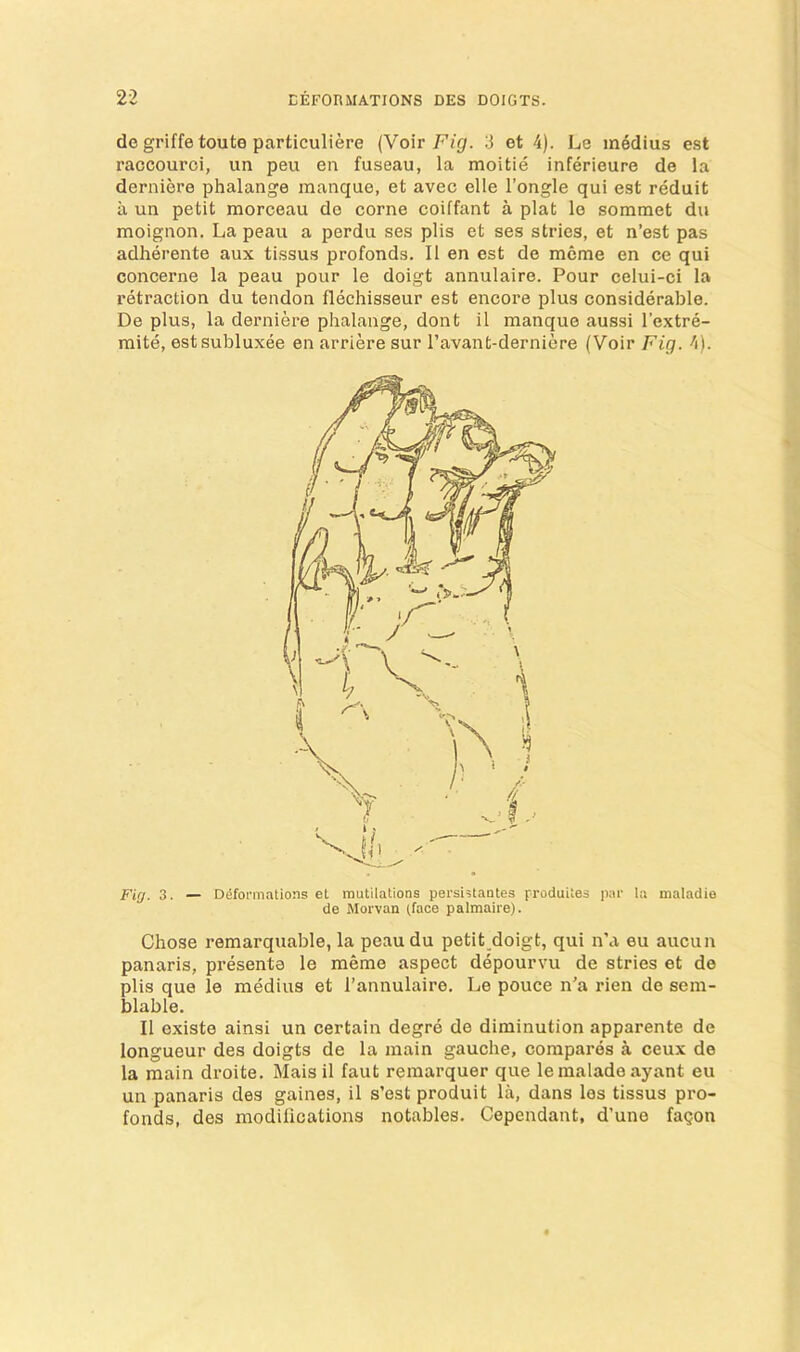 de griffe toute particuliere (Voir F/p. 3 ot 4). Le medius est raccouroi, un peu en fuseau, la moitie inferieure de la derniere phalange manque, et avec elle I’ongle qui est reduit a un petit morceau de come coiffant a plat le sommet du moignon. La peau a perdu ses plis et ses stries, et n’est pas adherente aux tissus profonds. II en est de mcme en ce qui concerne la peau pour le doigt annulaire. Pour celui-ci la retraction du tendon flechisseur est encore plus considerable. De plus, la derniere phalange, dont il manque aussi I’extre- mite, est subluxee en arriere sur Pavant-derniere (Voir Fig. 4). Fiff. 3. — Defoi-mations et mutilations pei'sistaotes produites par la maladie de Morvan (face palmaire). Chose remarquable, la peau du petit doigt, qui n’a eu aucun panaris, presenta le meme aspect depourvu de stries et de plis que le medius et I’annulaire. Le pouce n’a rien de sem- blable. II existe ainsi un certain degre de diminution apparente de longueur des doigts de la main gauche, compares a ceux de la main droite. Mais il faut remarquer que lemalade ayant eu un panaris des gaines, il s’est produit la, dans les tissus pro- fonds, des modifications notables. Cependant, d’une fagon