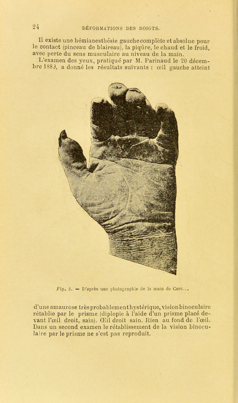II existeune hemianesthesie gauche complete et absolue pour le contact (pinceau de blaireau), la piqure, le chaud et le froid, avec perte du sens musculairc au niveau de la main. L’examen des yeux, pratique par M. Parinaud le 20 decem- brel883, a donne les resultats suivants : ceil gauche atteint Fig. S. — D’apres une iiholograpliie de la main de Care... d’uneamaurose tresprobablementhysterique, vision binoculaire retablie par le prisme (diplopie a I’aide d’un prisme place de- vant I’ceil droit, sain), ffiil droit sain. Rien au fond de I’ceil. Dans un second examen le retablissement de la vision binocu- laire par le prisme ne s’est pas reproduit.