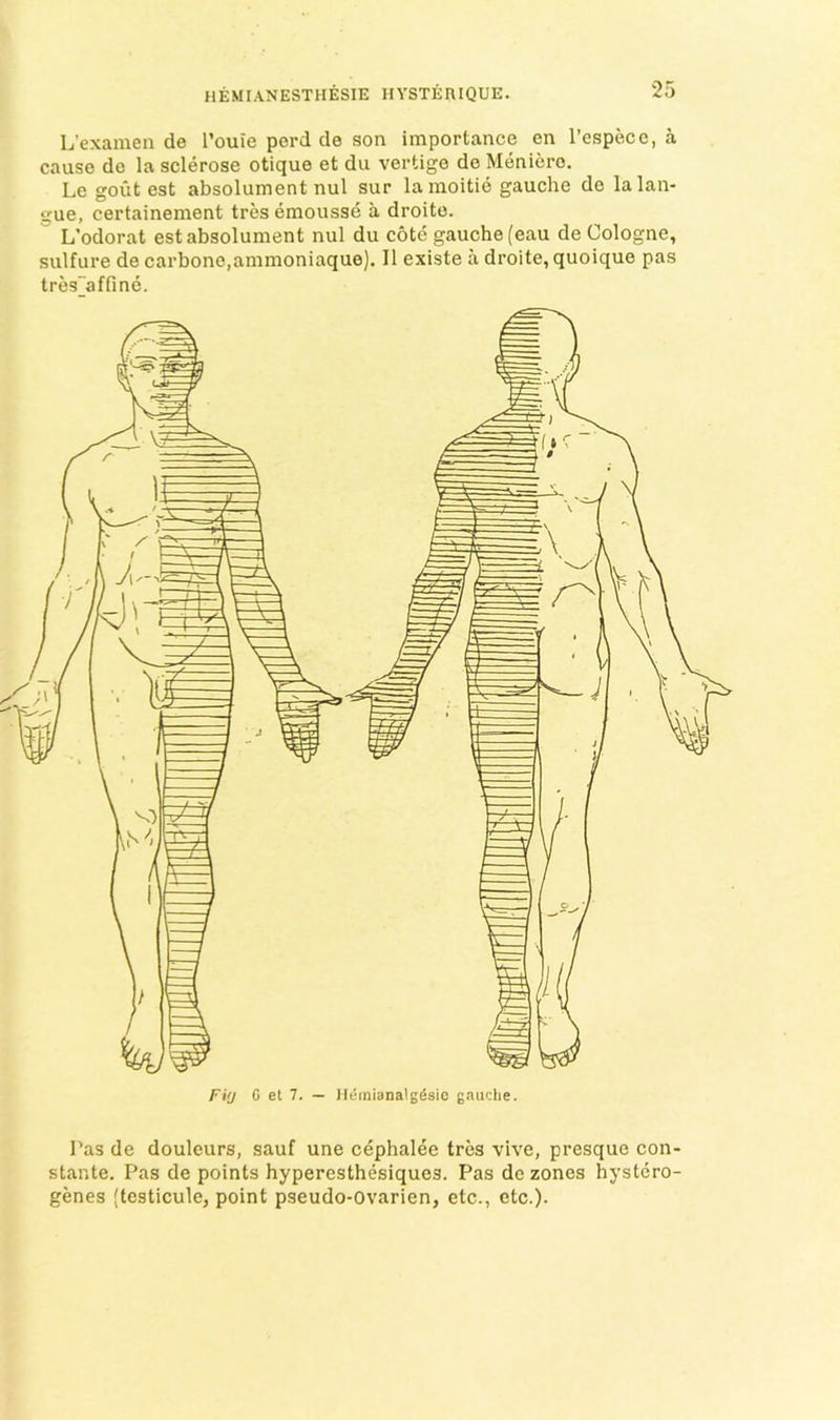HEMIANESTHESIE HYSTERIQUE. L’examen de Touie perd de son importance en I’espece, a cause do la sclerose otique et du vertigo de Meniere. Le goiit est absolument nul sur la moitie gauche de lalan- gue, certainement tres emousse a droito. L’odorat est absolument nul du cote gauche (eau de Cologne, sulfure de carbone,ammoniaque). II existe a droite, quoique pas tres~affine. F'kj C et 7. — lleinianalgSsic gauche. Pas de douleurs, sauf une cephalee tres vive, presque con- stante. Pas de points hyperesthesiques. Pas de zones hystero- genes (testicule, point pseudo-Ovarien, etc., etc.).