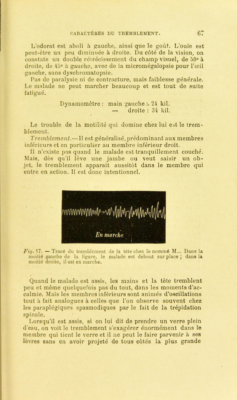 L’odorat est aboli h gauche, ainsi que le gouf. L’ouio est pcut-ctre un peu dimimiee h droito. Du cote de la vision, on constate un double reirecisscment du champ visuel, de 50® i droite, de 45® a gauche, avcc de la micromegalopsie pour I’ceil gauche, sans dyschromalopsie. Pas de paralysie ni de contracture, mais faiblesse generalo. Le malade ne pout marcher beaucoup et est tout do suite fatigue. Dynamomfctre : main gauche 24 kil. — droite : 34 kil. Le trouble de la motilite qui domine chez lui e^t le trem- blement. Tremblement.— II est generalise, predominant aux membres inferieurs et on particulier au membre inferieur droit. II n’cxiste pas quand le malade est tranquillement couche. Mais, des qu’il leve une jambe ou veut saisir un ob- jet, le tremblement apparait aussitot dans le membre qui entre en action. II est done intentionncl. Fig. 17. —Trac6 du tremblement de la t6te chez le nomm6 M... Dans la moiti6 gauche de la figure, le malade est debout sur place ; dans la moiti6 droite, il est en marche. Quand le malade est assis, les mains et la tete tremblent peu et mcme quelquefois pas du tout, dans les moments d’ac- calmie. Mais les membres inferieurs sont animes d’oscillations tout a fait analogues a celles que I’on observe souvent chez les paraplegiques spasmodiques par le fait de la trepidation spinale. Lorsqu’il est assis, si on lui dit de prendre un verre plein d’eau, on voit le tremblement s’exagerer enormement dans le membre qui tient le verre et il ne peut le fairo parvenir a ses levres sans en avoir projete de tous cotes la plus grande