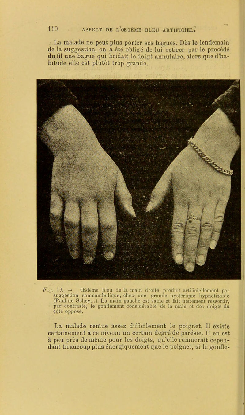 La malade ne peut plus porter ses bagues. Des le lendemain de la suggestion, on a ete oblige de lui retirer par le precede du fil une bague qui bridait le doigt annulaire, alors que d’ha- bitude elle est plutot trop grande. Fij. IJ. — (Edeme bleu de la main droite, produit artlficiellement par suggestion somnarabulique, chez une grande hysterique liypnotisablo (Pauline Schey...). La main gauche est saine et fait nettement ressortir, par contraste, le gonflement considerable de la main et des doigts du cOte oppose. La malade renlue assez diflicilement le poignet. II existe certainement a ce niveau un certain degre de paresie. II en est a peu pros de memo pour les doigts, qu’elle remuerait cepen- dant beaucoup plus energiquement que le poignet, si le gonfle-