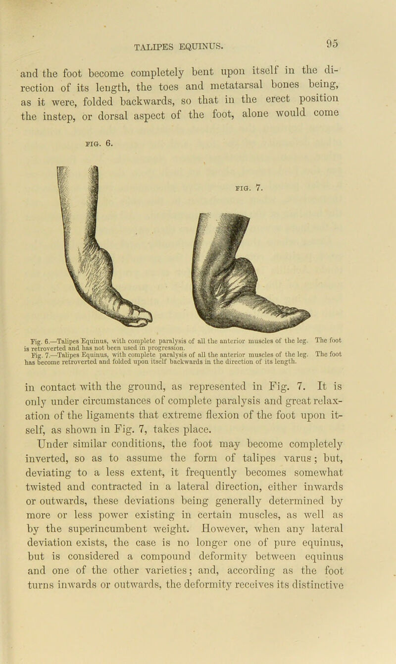 and the foot become completely bent upon itself in the di- rection of its length, the toes and metatarsal bones being, as it were, folded backwards, so that in the erect position the instep, or dorsal aspect of the foot, alone would come FIG-. 6. Fig. 6.—Talipes Equinus, with complete paralysis of all the anterior muscles of tlie leg. The foot is retroverted and has not been used in progression. Fig. 7.—Talipes Equinus, with complete paralysis of all the anterior muscles of the leg. The foot has become retroverted and folded upon itself backwards in the direction of its length. in contact with the ground, as represented in Fig. 7. It is only under circumstances of complete paralysis and great relax- ation of the ligaments that extreme flexion of the foot upon it- self, as shown in Fig. 7, takes place. Under similar conditions, the foot may become completely inverted, so as to assume the form of talipes varus; but, deviating to a less extent, it frequently becomes somewhat twisted and contracted in a lateral direction, either inwards or outwards, these deviations being generally determined by more or less power existing in certain muscles, as well as by the superincumbent weight. However, when any lateral deviation exists, the case is no longer one of pure equinus, but is considered a compound deformity between equinus and one of the other varieties; and, according as the foot turns inwards or outwards, the deformity receives its distinctive