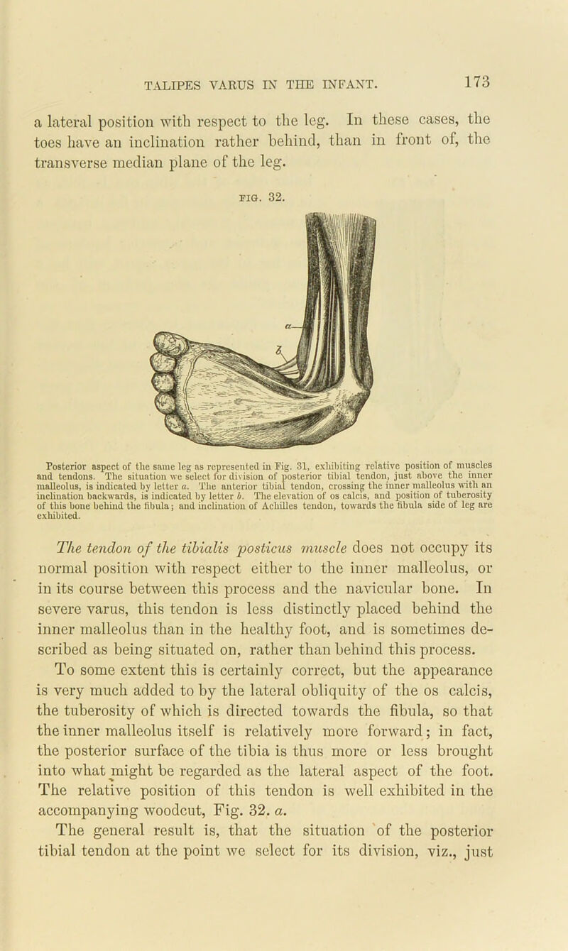 a lateral position with respect to the leg. In these cases, the toes have an inclination rather behind, than in front of, the transverse median plane of the leg. pig. 32. Posterior aspect of tlie same leg as represented in Pig. 31, exhibiting relative position of muscles and tendons. The situation we select for division of posterior tibial tendon, just above the inner malleolus, is indicated by letter «. The anterior tibial tendon, crossing the inner malleolus with an inclination backwards, is indicated by letter b. The elevation of os calcis, and position of tuberosity of this bone behind the fibula; and inclination of Achilles tendon, towards the fibula side of leg are exhibited. The tendon of the tibialis posticus muscle does not occupy its normal position with respect either to the inner malleolus, or in its course between this process and the navicular bone. In severe varus, this tendon is less distinctly placed behind the inner malleolus than in the healthy foot, and is sometimes de- scribed as being situated on, rather than behind this process. To some extent this is certainly correct, but the appearance is very much added to by the lateral obliquity of the os calcis, the tuberosity of which is directed towards the fibula, so that the inner malleolus itself is relatively more forward; in fact, the posterior surface of the tibia is thus more or less brought into what might be regarded as the lateral aspect of the foot. The relative position of this tendon is well exhibited in the accompanying woodcut, Fig. 32. a. The general result is, that the situation of the posterior tibial tendon at the point we select for its division, viz., just