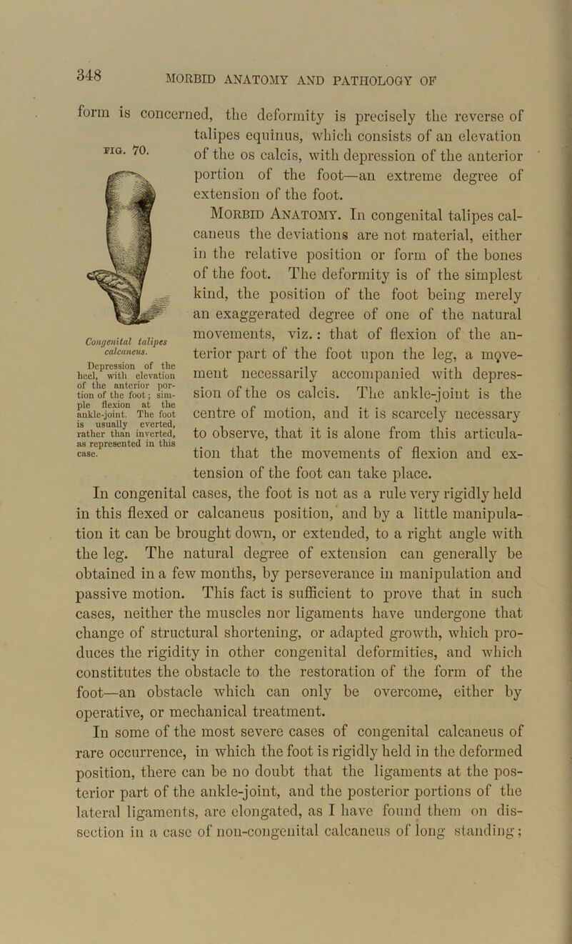 MORBID ANATOMY AND PATHOLOGY OF form is concerned, the deformity is precisely the reverse of talipes equinus, which consists of an elevation of the os calcis, with depression of the anterior portion of the foot—an extreme degree of extension of the foot. Morbid Anatomy. In congenital talipes cal- caneus the deviations are not material, either in the relative position or form of the bones of the foot. The deformity is of the simplest kind, the position of the foot being merely an exaggerated degree of one of the natural movements, viz.: that of flexion of the an- terior part of the foot upon the leg, a move- ment necessarily accompanied with depres- sion of the os calcis. The ankle-joint is the centre of motion, and it is scarcely necessary to observe, that it is alone from this articula- tion that the movements of flexion and ex- tension of the foot can take place. In congenital cases, the foot is not as a rule very rigidly held in this flexed or calcaneus position, and by a little manipula- tion it can be brought down, or extended, to a right angle with the leg. The natural degree of extension can generally be obtained in a few months, by perseverance in manipulation and passive motion. This fact is sufficient to prove that in such cases, neither the muscles nor ligaments have undergone that change of structural shortening, or adapted growth, which pro- duces the rigidity in other congenital deformities, and which constitutes the obstacle to the restoration of the form of the foot—an obstacle which can only be overcome, either by operative, or mechanical treatment. In some of the most severe cases of congenital calcaneus of rare occurrence, in which the foot is rigidly held in the deformed position, there can be no doubt that the ligaments at the pos- terior part of the ankle-joint, and the posterior portions of the lateral ligaments, are elongated, as I have found them on dis- section in a case of non-congenital calcaneus of long standing; FIG. 70. Congenital talipes calcaneus. Depression of the heel, with elevation of the anterior por- tion of the foot; sim- ple flexion at the ankle-joint. The foot is usually everted, rather than inverted, os represented in tliis case.