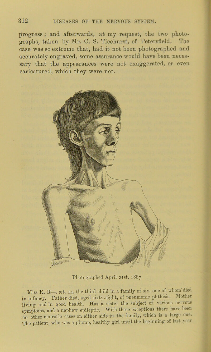 progress; and afterwards, at my request, the two photo- graphs, taken by Mr. C. S. Ticehurst, of Petersfield. The case was so extreme that, had it not been photographed and accurately engraved, some assurance would have been neces- sary that the appearances were not exaggerated, or even caricatured, which they were not. Photographed April 21st, 1S87. Miss Iv. R—, set. 14, the third child in a family of six, one of wliom'died in infancy. Father died, aged sixty-eight, of pneumonic phthisis. Mother living and in good health. Has a sister the subject of various nervous symptoms, and a nephew epileptic. With these exceptions there have been no other neurotic cases on either side in the family, which is a large one. The patient, who was a plump, healthy girl until the beginning of last yem