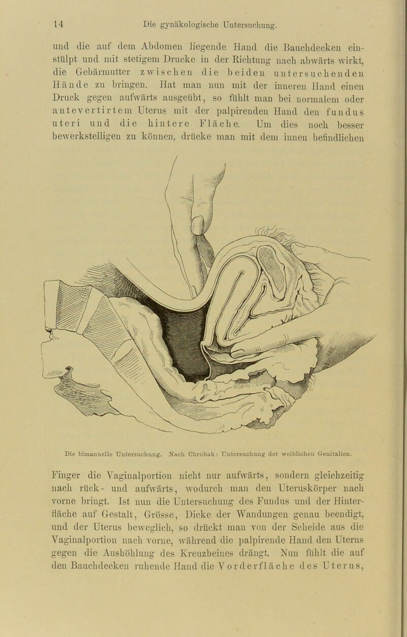 und die auf dem Abdomen liegende Hand die Bauchdecken ein- stülpt und mit stetigem Drucke in der Richtung nach abwärts wirkt, die Gebärmutter zwischen die beiden untersuchenden Hände zu bringen. Hat man nun mit der inneren Hand einen Druck gegen aufwärts ausgeübt, so fühlt man bei normalem oder anteverti r tem Uterus mit der palpireuden Hand den fundus uteri und die hintere Fläche. Um dies noch besser bewerkstelligen zu könuen, drücke man mit dem innen befindlichen Die bimanuelle Untersuchung. Nach Chrobak: Untersuchung der weiblichen Genitalien. Finger die Vaginalportion nicht nur aufwärts, sondern gleichzeitig nach rück- und aufwärts, wodurch mau den Uteruskörper nach vorne bringt. Ist nun die Untersuchung des Fundus und der Hinter- fläche auf Gestalt, Grösse, Dicke der Wandungen genau beendigt, und der Uterus beweglich, so drückt mau von der Scheide aus die Vaginalportion nach vorne, während die palpirende Hand den Uterus gegen die Aushöhlung des Kreuzbeines drängt. Nun fühlt die auf den Bauchdecken ruhende Hand die Vor der fläche des Uterus,