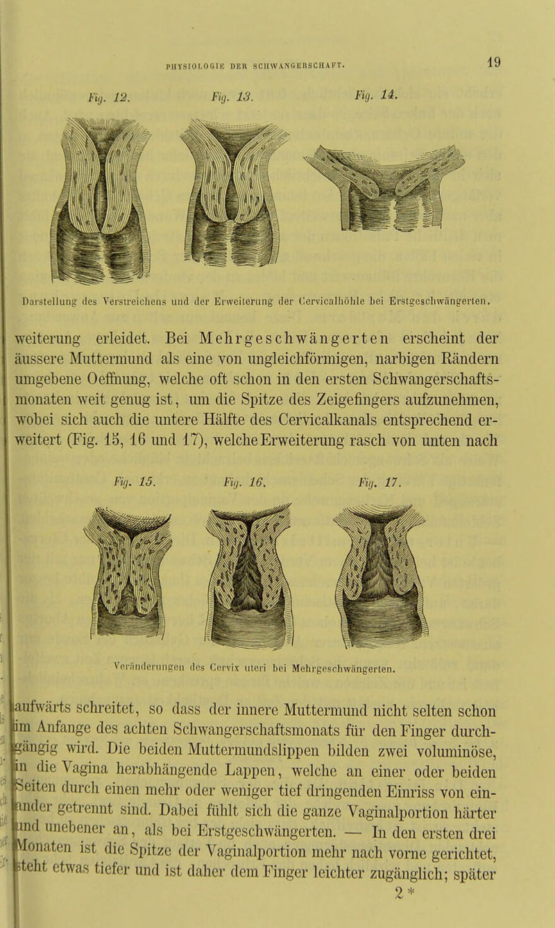 PHYSIOI.OGIK DEll .SCllW.VNC.ERSCIIAKT. Weiterung erleidet. Bei Mehr geschwängerten erscheint der äussere Muttermund als eine von ungleichförmigen, narbigen Rändern umgebene Oeffhung, welche oft schon in den ersten Schwangerschafts- monaten weit genug ist, um die Spitze des Zeigefingers aufzunehmen, w'obei sich auch die untere Hälfte des Cervicalkanals entsprechend er- weitert (Fig. 15, 16 und 17), welche Erweiterung rasch von unten nach Fig. 15. Fig. 16. Fig. 17. Vci'ändcrungeii des Cervix uteri bei Mehrgeschwängerten. aufwärts schreitet, so dass der innere Muttermund nicht selten schon lim Anfange des achten Schwangerschaftsmonats für den Finger durch- gängig wird. Die beiden Muttermundslippen bilden zwei voluminöse, m die Vagina herabhängende Lappen, welche an einer oder beiden Seiten durch einen mehr oder weniger tief dringenden Einriss von ein- mder getrennt sind. Dabei fühlt sich die ganze Vaginalportion härter md unebener an, als bei Erstgeschwängerten. — In den ersten drei Monaten ist die Spitze der Vaginalportion mehr nach vorne gerichtet, steht etwas tiefer und ist daher dem Finger leichter zugänglich; später 2*