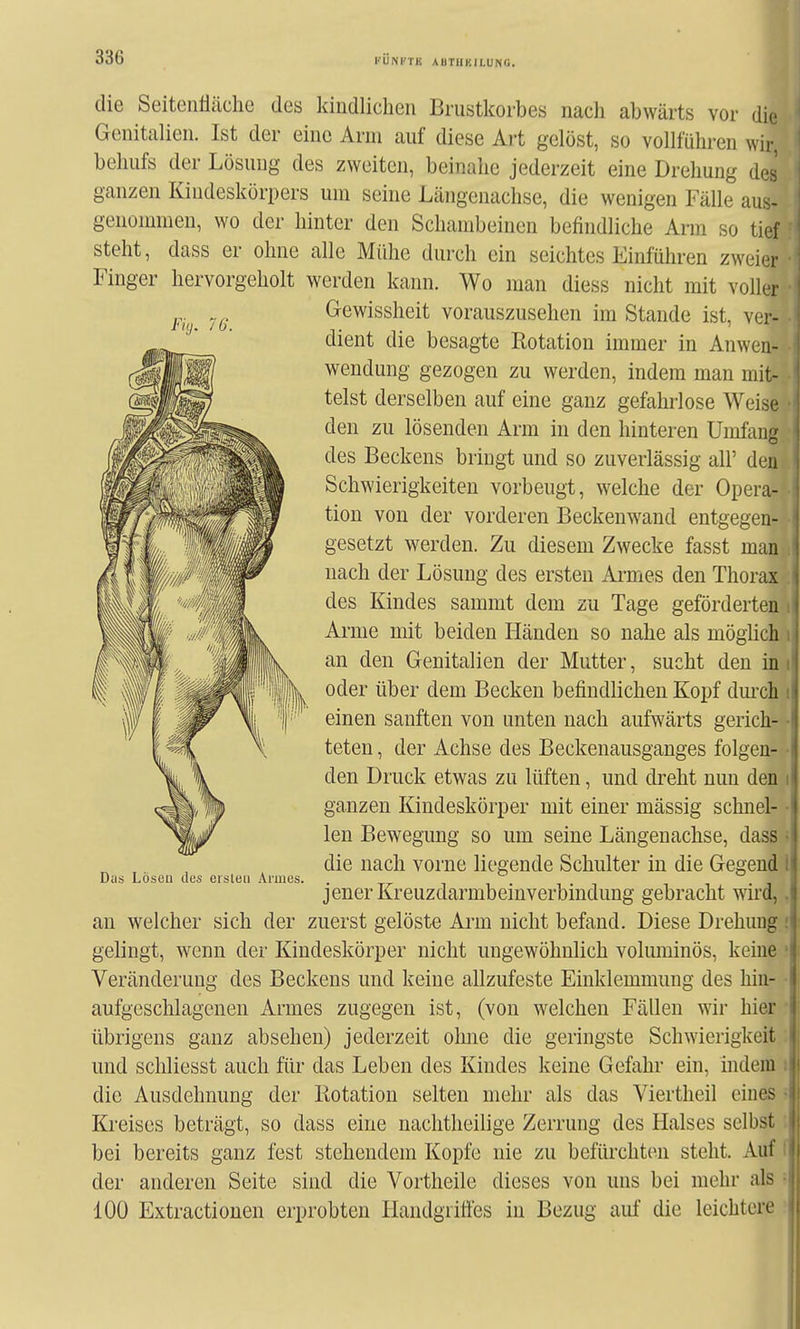 Fiij. 76. die Seitenfläche des kindlichen Brustkorbes nach abwärts vor die Genitalien. Ist der eine Arm auf diese Art gelöst, so vollführen wir, behufs der Lösung des zweiten, beinahe jederzeit eine Drehung des ganzen Kindeskörpers um seine Längenachse, die wenigen Fälle aus- genommen, wo der hinter den Schambeinen befindliche Arm so tief steht, dass er ohne alle Mühe durch ein seichtes Einführen zweier Finger hervorgeholt werden kann. Wo man diess nicht mit voller Gewissheit vorauszusehen im Stande ist, ver- dient die besagte Rotation immer in Anwen- wendung gezogen zu werden, indem man mit- telst derselben auf eine ganz gefahrlose Weise den zu lösenden Arm in den hinteren Umfang des Beckens bringt und so zuverlässig all' den Schwierigkeiten vorbeugt, welche der Opera- tion von der vorderen Beckenwand entgegen- gesetzt werden. Zu diesem Zwecke fasst man nach der Lösung des ersten Ai-mes den Thorax des Kindes sammt dem zu Tage geförderten Arme mit beiden Händen so nahe als mögüch an den Genitalien der Mutter, sucht den in oder über dem Becken befindlichen Kopf dm'ch einen sanften von unten nach aufwärts gerich- teten , der Achse des Beckenausganges folgen- den Druck etwas zu lüften, und dreht nun den ganzen Kindeskörper mit einer mässig schnel- len Bewegung so um seine Längenachse, dass die nach vorne liegende Schulter in die Gegend jener Kreuzdarmbeinverbindung gebracht wird, an welcher sich der zuerst gelöste Ai'm nicht befand. Diese Drehung gelingt, wenn der Kindeskörper nicht ungewöhnlich voluminös, keine Veränderung des Beckens und keine allzufeste Einklemmung des hin- aufgeschlagenen Armes zugegen ist, (von welchen Fällen wir hier übrigens ganz absehen) jederzeit ohne die geringste Schwierigkeit und schliesst auch für das Leben des Kindes keine Gefahr ein, mdem die Ausdehnung der Kotation selten mehr als das Viertheil eine? Kreises beträgt, so dass eine naclitheilige Zerrung des Halses selbst bei bereits ganz fest stehendem Kopfe nie zu befürchten steht. Auf der anderen Seite sind die Vortheile dieses von uns bei mehr als 100 Extractionen erprobten Handgritfes in Bezug auf die leichtere Das Lösen des eisten Armes. I I i1