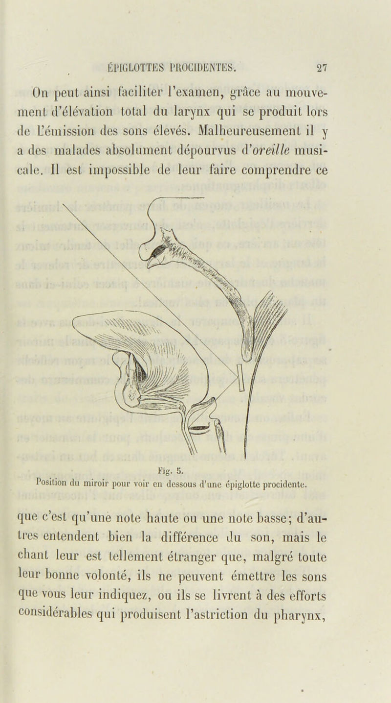 Ou peut ainsi facililer l’examen, grâce au mouve- ment d’élévation total du larynx qui se produit lors de L’émission des sons élevés. Malheureusement il y a des malades absolument dépourvus iVoreille musi- cale. Il est impossible de leur faire comprendre ce Position du miroir pour voir en dessous d’une épiglotte procidenle. que c’est qu’une note haute ou une note basse; d’au- tres entendent bien la différence du son, mais le chant leur est tellement étranger que, malgré toute leur bonne volonté, ils ne peuvent émettre les sons que vous leur indiquez, ou ils se livrent à des efforts considérables qui produisent l’astriction du pharynx,