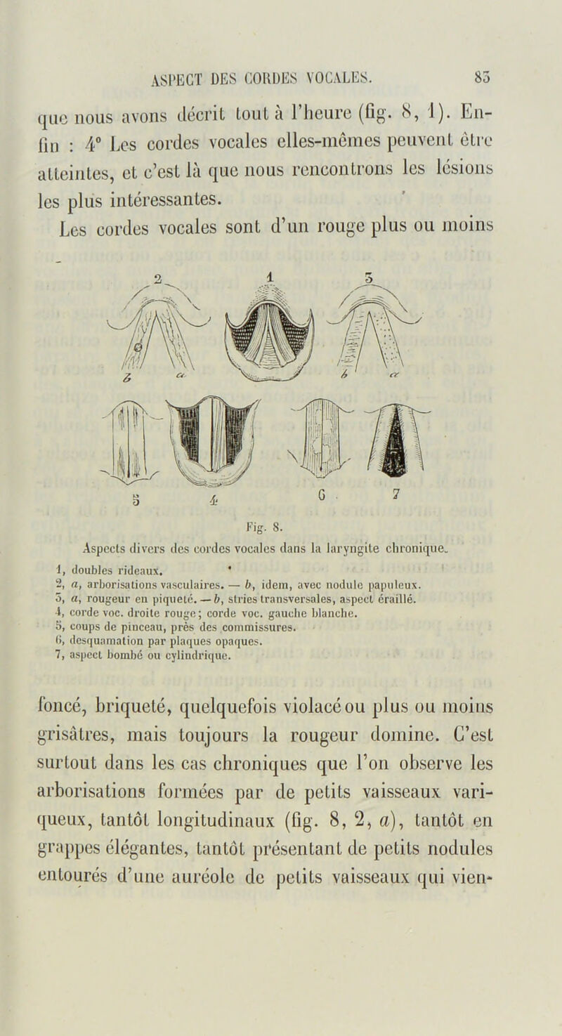 (jiic nous avons décrit tout a 1 lieurc (fig. S, 1). En- lin : 4® Les cordes vocales elles-nicines penvenl cLi c alLeinlcs, et c’est là que nous rencontrons les lésions les plus intéressantes. Les cordes vocales sont d’un rouge plus ou moins Fig. 8. Aspects divers des cordes vocales dans la laryngite chronique. 1, doubles rideaux. ' 2, a, arborisations vasculaires. — b, idem, avec nodule papuleux. 5, a, rougeur eu piqueté.— b, stries transversales, aspect éraillé. ■1, corde voc. droite rouge ; corde voc. gauche blanche. 5, coups de pinceau, près des commissures. (>, desquamation par plaques opaques. 7, aspect bombé ou cylindrique. foncé, briqueté, quelquefois violacé ou plus ou moins grisâtres, mais toujours la rougeur domine. C’est surtout dans les cas chroniques que l’on observe les arborisations formées par de petits vaisseaux vari- queux, tantôt longitudinaux (fig. 8, 2, a), tantôt en grappes élégantes, tantôt présentant de petits nodules entourés d’une auréole de petits vaisseaux qui vieil*