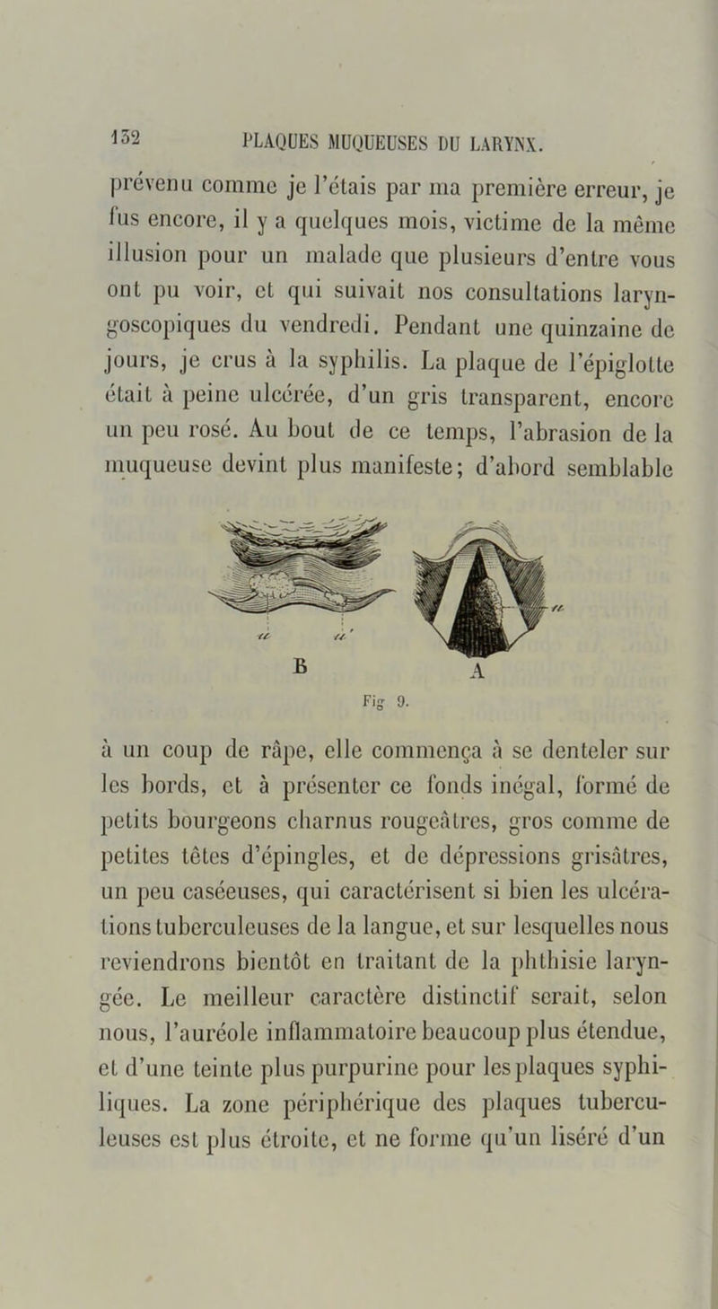 prévenu comme je l’étais par ma première erreur, je lus encore, il y a quelques mois, victime de la même illusion pour un malade que plusieurs d’entre vous ont pu voir, et qui suivait nos consultations laryn- goscopiques du vendredi. Pendant une quinzaine de jours, je crus à la syphilis. La plaque de l’épiglotte était à peine ulcérée, d’un gris transparent, encore un peu rosé. Au bout de ce temps, l’abrasion de la muqueuse devint plus manifeste; d’abord semblable Fig 9. à un coup de râpe, elle commença à se denteler sur les bords, et à présenter ce fonds inégal, formé de petits bourgeons charnus rougeâtres, gros comme de petites têtes d’épingles, et de dépressions grisâtres, un peu caséeuses, qui caractérisent si bien les ulcéra- tions tuberculeuses de la langue, et sur lesquelles nous reviendrons bientôt en traitant de la phthisie laryn- gée. Le meilleur caractère distinctif serait, selon nous, l’auréole inflammatoire beaucoup plus étendue, et d’une teinte plus purpurine pour les plaques syphi- liques. La zone périphérique des plaques tubercu- leuses est plus étroite, et ne forme qu’un liséré d’un