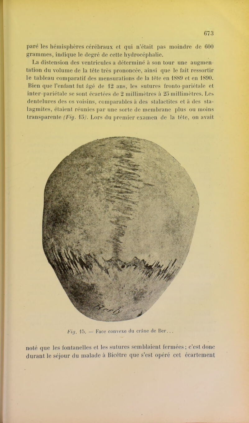 pare les hemispheres cerehraiix et qui n’cHait. pas moinclre de 600 grammes, indique le degre de cette hydrocephalie. La distension des venlriculesa determine a son tour line augmen- tation dll volume de la tete tres prononcee, ainsi que le fait ressortir le tableau coinparalif des mensurations de la tele en 1880 et en 1890. Hien que I’enfant fut age de 12 ans, les sutures fronto parietale et inter-pariiMale se sont ccartees de 2 millimetres a 25 millimetres. Les dentelures des os voisins, eom|)arahles a des stalactites et a des sta- lagmites, etaient reuiiies par ime sorte de memhranc plus ou moins transparente (F/f/. 15j. Lors du premier e.xamen de la tele, on avait Fifj. 15. — Face convcxe du ci’aiie de Her... note que les fontanelles et les sutures semhlaient fermees; c’est done dnrant le sejour du nialade a Bicetre que s’est optu-e cet ecartemenl